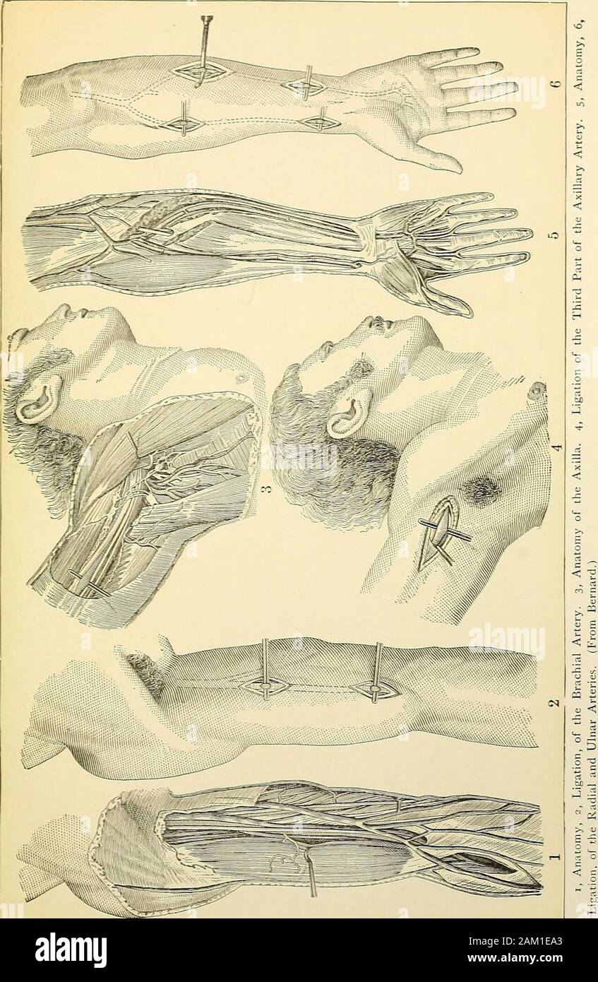 La chirurgie moderne, général et du dispositif . à lavis du coude. Elle est traversée par aucun muscle, et est, en fait, superficielle, sous réserve de sa étant quelque peu superposées dans une partie de son cours par le bord d'thebiceps muscle. Le nerf médian est externe au-dessus, traverse le vesselabout le milieu du bras, et atteint le côté intérieur de l'artère. Thecoracobrachialis et muscles biceps sont externes, et les deux overlapthe souvent navire. Le nerf cubital est interne au-dessus, et le nerf médian est en-dessous de l'émission au milieu. Le basihc veine est à l'intérieur de l'artère,étant en dehors de l'aponévrose profonde t Banque D'Images