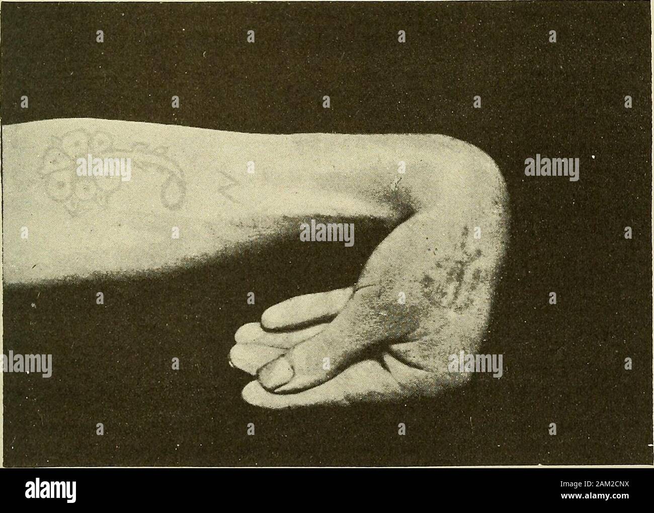 La thérapie médicale et chirurgicale . S Y LE DÉPUTÉ TOM UN TOLOG Y 525 de subluxation. Le contour de chaque doigt qui thusresembles d'un projet de loi à leur tête de canne. Le pouce est habituellement appliqué étroitement à la main byits frontière interne ; la première phalange est plus frequentlystrongly fléchis ; la dernière phalange est prolongée ou iseven dans un état de l'hyperextension, et son extremityfits dans le sillon formé par les autres doigts. Wemay ajouter que le petit doigt subit parfois des amovement de rotation vers l'intérieur, afin que la pulpe de la phalange des visages qui itslast du pouce. L'hypothénar thenarand les cardinaux viennent fermer togethe Banque D'Images
