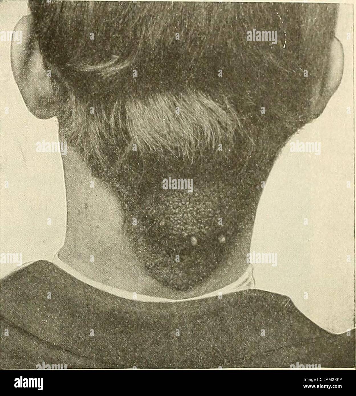 La chirurgie moderne, général et du dispositif . Les tissus conjonctifs des principales glandes surrénales,mais aussi dans les reins, le lobe droit du foie, le long de la vaisseaux rénaux andspermatic veines, dans le canal inguinal, et dans les grandes orientations des ligaments (Amer ican-Text-Book de pathologie). Les tumeurs épithéliales innocent.-Ces excroissances imiter un epithelialtissue de l'organisme sain et mature. Papillomata, ou des verrues génitales (Fig. 176).-Papillomata sont formées sur thet3^e de papilles cutanées et des muqueuses. Un papillomavirus se compose d'un fibrousstroma, qui contient des vaisseaux sanguins et lymphatiques et est couvert par l'epithe-lium de l'v Banque D'Images La chirurgie moderne, général et du dispositif . Les tissus conjonctifs des principales glandes surrénales,mais aussi dans les reins, le lobe droit du foie, le long de la vaisseaux rénaux andspermatic veines, dans le canal inguinal, et dans les grandes orientations des ligaments (Amer ican-Text-Book de pathologie). Les tumeurs épithéliales innocent.-Ces excroissances imiter un epithelialtissue de l'organisme sain et mature. Papillomata, ou des verrues génitales (Fig. 176).-Papillomata sont formées sur thet3^e de papilles cutanées et des muqueuses. Un papillomavirus se compose d'un fibrousstroma, qui contient des vaisseaux sanguins et lymphatiques et est couvert par l'epithe-lium de l'v Banque D'Images