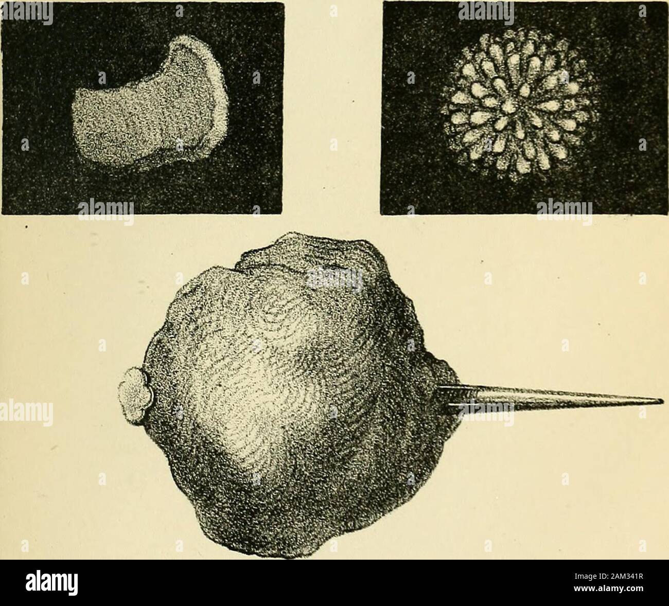 Des inflammations et catarrhe de la vessie, gravelle, des divers moyens de combattre ces sentiments . Calcul développé autour dune aiguille un tête divoire .La malade fut opérée,avec succès, par ZAMPOLO 3e PARME (Mémoires Je lAcaâeTme Chirurgie Tome ii il ! . P.TR Banque D'Images