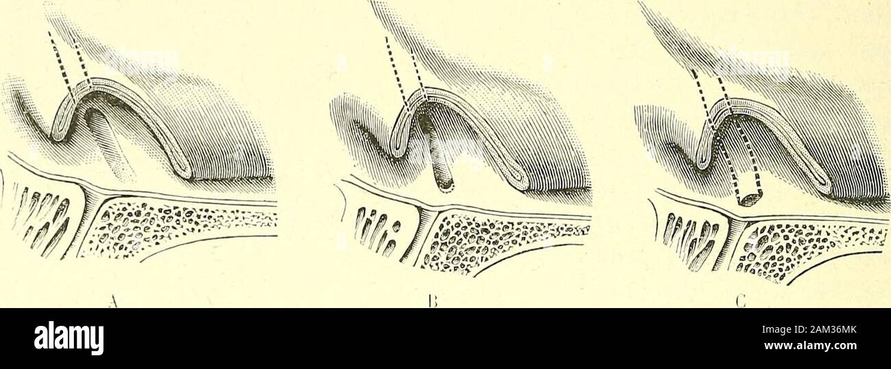 Traité d'anatomie humaine . cloison - 3, cornet,moyen. - 4, du cornet inférieur. - 5, méat inférieur. - Lacrjmal,sac;J, avec 6, l'orifice des conduils lacrj-niaiix. - 7, canal nasale. - 8 fils, inférieur de l'orifice. - !I, valvule de Hasner - 10 cUnnoï ilalos-, cellules. - 11, deuxième prémolaire. - 12, sinusmaxillaire. 526 ORGANES DES SENS bien obliquement en bas et en arrière (fig. 372, A et B). A un degré dallonge-ment plus vertical prononcé, lorifice ovalaire devient une simple fente, avec unelèvre antérieure et une lèvre postérieure souvent très rapprochées ou même jux-taposées (fig. 372, D). Nes 11 Banque D'Images