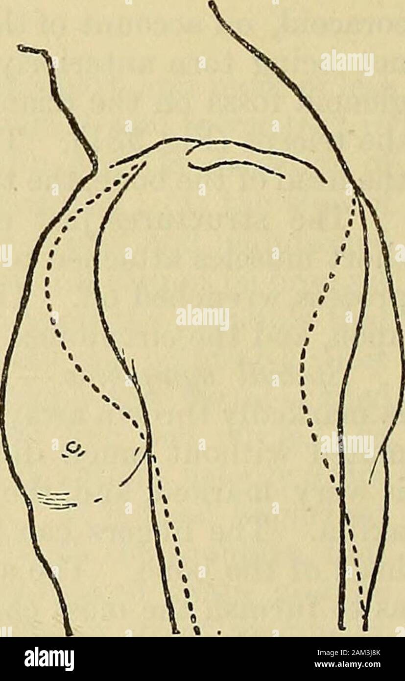 Un système de chirurgie . eductioncould pas être effectuée, mais thearm a été ramené à côté. 3. Subclavicular dés-emplacement de l'humérus. L'anatomie. Cette dislocationmay - être considéré comme pri-rels, subcoracoid mais themuscles, et peut-être la correction de di-causethe la vigueur, chef de l'os pour passunder la clavicule et la face interne de l'Apophyse coracoïde (Fig.384). Ici il se trouve sur la partie supérieure de l'ribsbeneath forminga, muscle pectoral d'importance manifeste. Le capsuleis est déchiré et en avant ; les muscles et attaché à l'greattuberosity doivent être déchirés, ou que d'processseparated Banque D'Images
