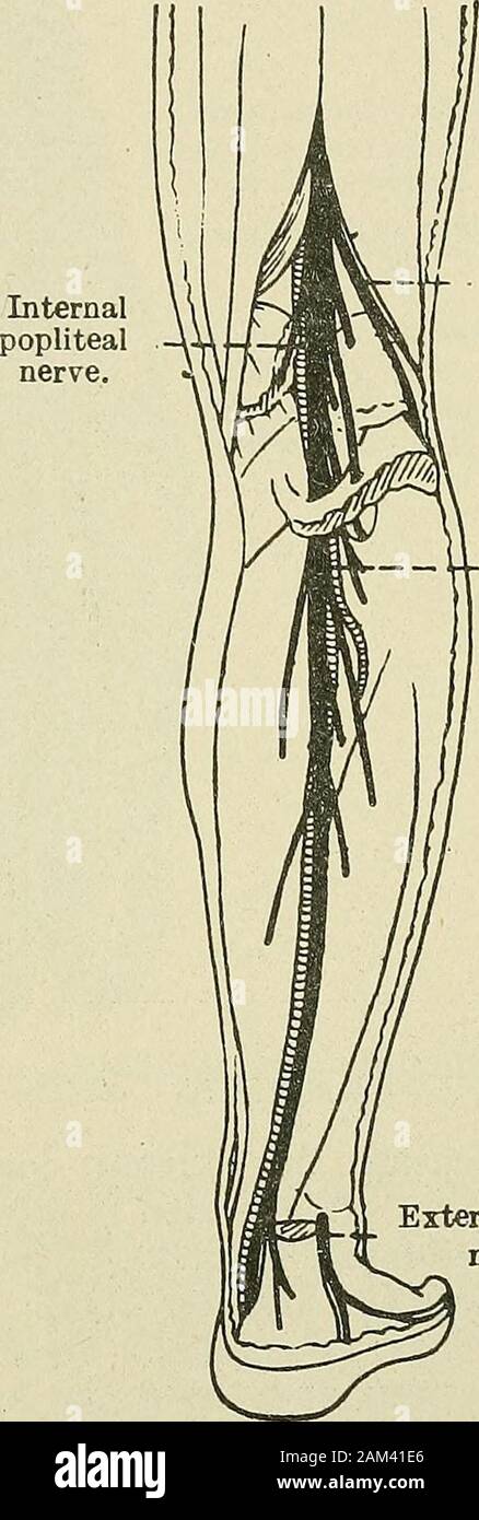 La thérapie médicale et chirurgicale . Direction générale interne d'niusculo-. cutanée. Externalpoplitealnerve. Tibialnerve postérieure. Saphenousnerve externe. Fig. 64 -Troubles musculo-cutané, andanterior nerfs tibiaux. Fig. 65.-poplité interne andposterior nerfs tibiaux. Le grand nerf sciatique, découle de l'angle supérieur de la veine d'espace.Il passe le long du tendon de theijiceps et derrière la tête de thefibula, *minding autour du cou de cet os, qui est le chosenfor la palpation de ce nerf, puis se termine en divisant dans lavis des insertions de l'orteil péroniers latéraux (fig. 64). 156 FORMES CLINIQUES DE N Banque D'Images