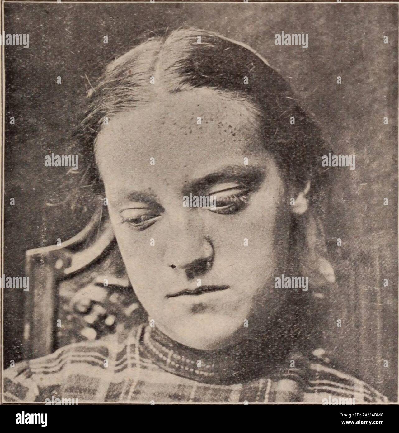 Interstate medical journal . la clinique quatre jours plus tard, theskin a montré une nette amélioration, la plupart des lésions distinctes présentant evi-ance d'aplatissement, avec l'ensemble d'absence de nouvelles. Une semaine plus tard, sous l'administration régulière de sulfate de magnésium et de l'utilisation d'lotionlocally resorcin, la peau du visage avaient complètement disparu, tandis que sur les mains qu'un fewlesions persistent. Lorsque le patient a été vu un mois plus tard, le onlyevidence de l'ancienne éruption a été la présence de quelques petites, isolées, hardpapules sur le dos de la main. Cas II.-Myrtle C., l'âge de douze ans, Banque D'Images