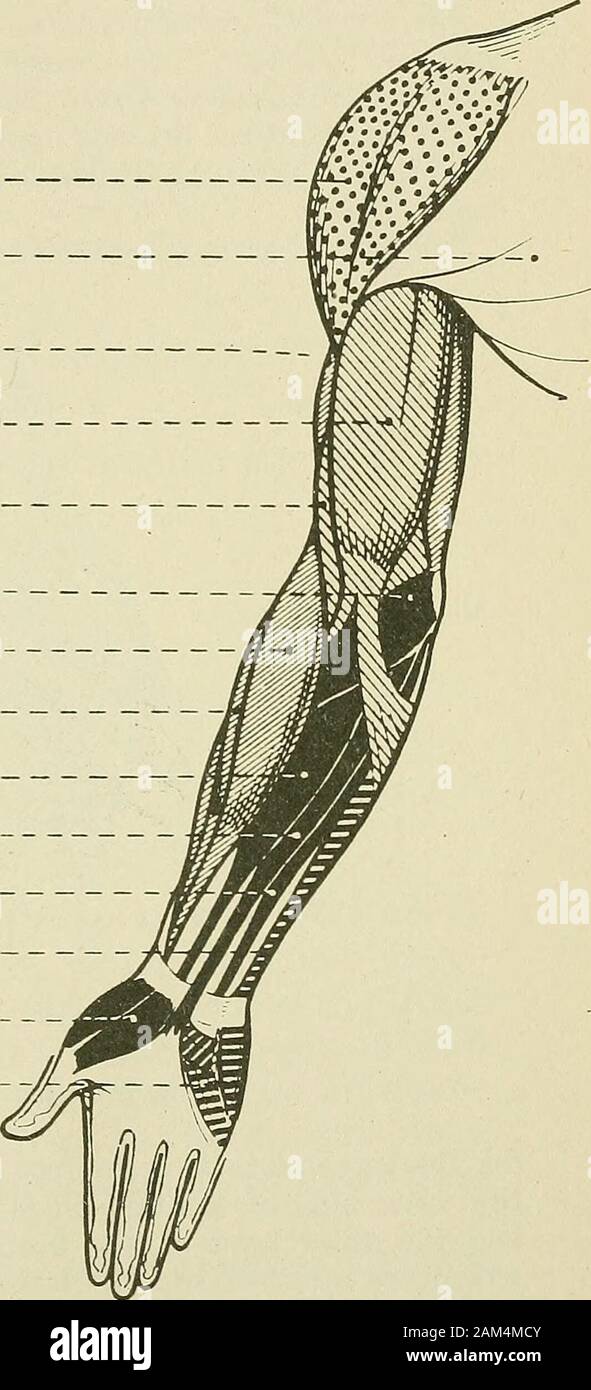 La thérapie médicale et chirurgicale . mouvement pour elle ; (2) le palmaris longus, whichflexes l'ensemble de celui-ci ; (3) l'appareil extenseur carpi ulnaris, qui flexesthe cinquième métacarpien plus ; (4) l'auteur de l'enlèvement de l'orteil abducteur du pouce, thoughnot près dans la même mesure. La flexion de la main est généralement effectuée par les co-operativeaction de ces différents muscles. Li plus, les fléchisseurs du nerf médian 53 contrat main fortement mais involontairement, lorsqu'il n'y a voluntarv^extension de l'hngers sur le metacaqjus. Quelle que soit la mav être dit au contraire, ces muscles, même les nerfs. Les racines. Accent circonflexe. C^ Miisculo- C. Banque D'Images