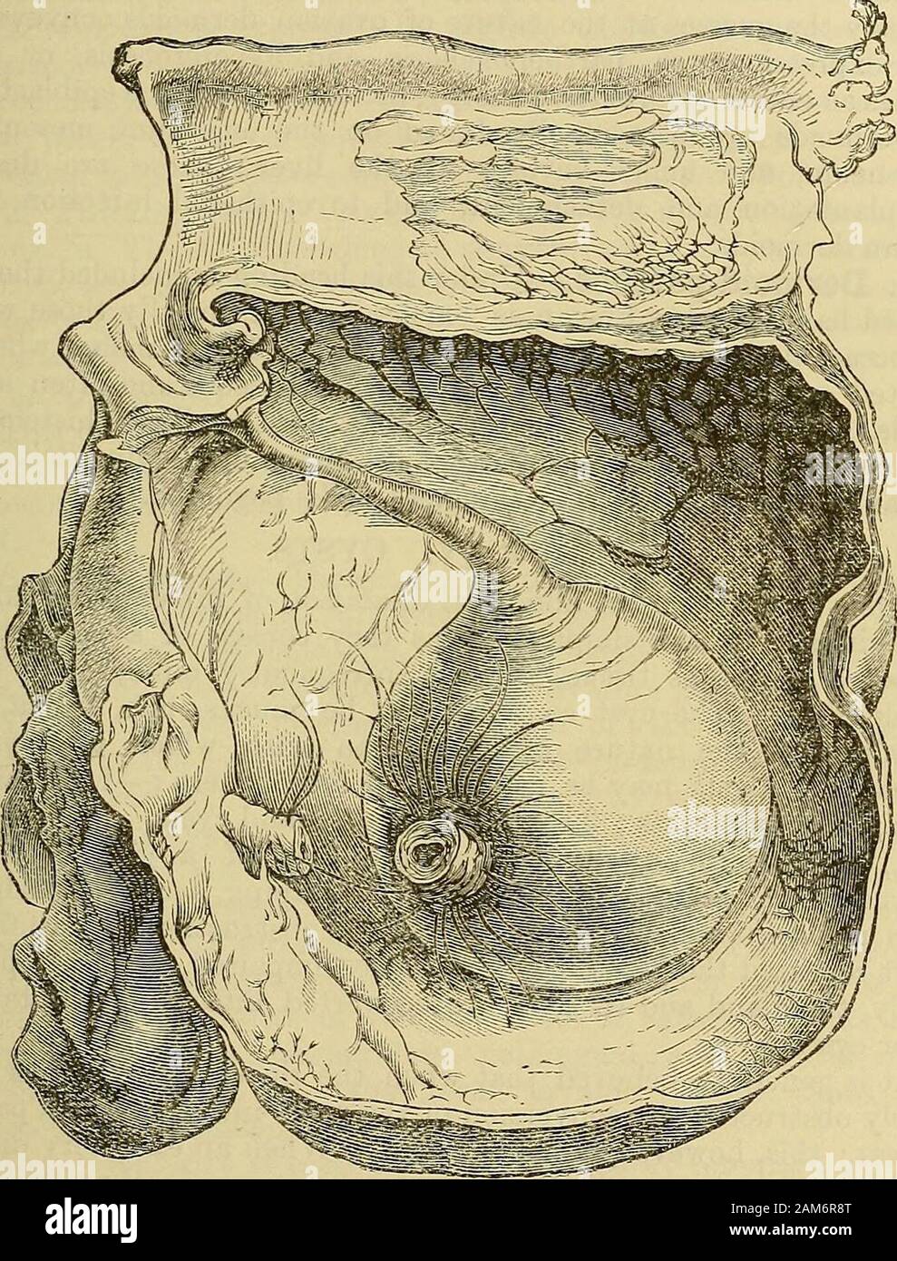 Un système de chirurgie . Il oftenattain très grandes proportions ; (6) présentent une structure plus complexe ;(c) et souvent contiennent des dents. 3. Dermoïdes de l'ovaire.-Ces tumeurs diffèrent des autres generaof dermoïdes en raison de leur mode d'origine et l'greatervariety dermique de structures qu'ils contiennent. C'est à partir de l'épithélium tapissant les follicules ovariennes qui themucous membrane, la peau et les structures cutanées sont dérivés, whichconstitute une telle fonctionnalité dans la majorité des ovariandermoids. Dermoïdes de l'ovaire n'est pas uniquement le cas de la séquestration andtubulo-dermoïdes dans leur complexit Banque D'Images
