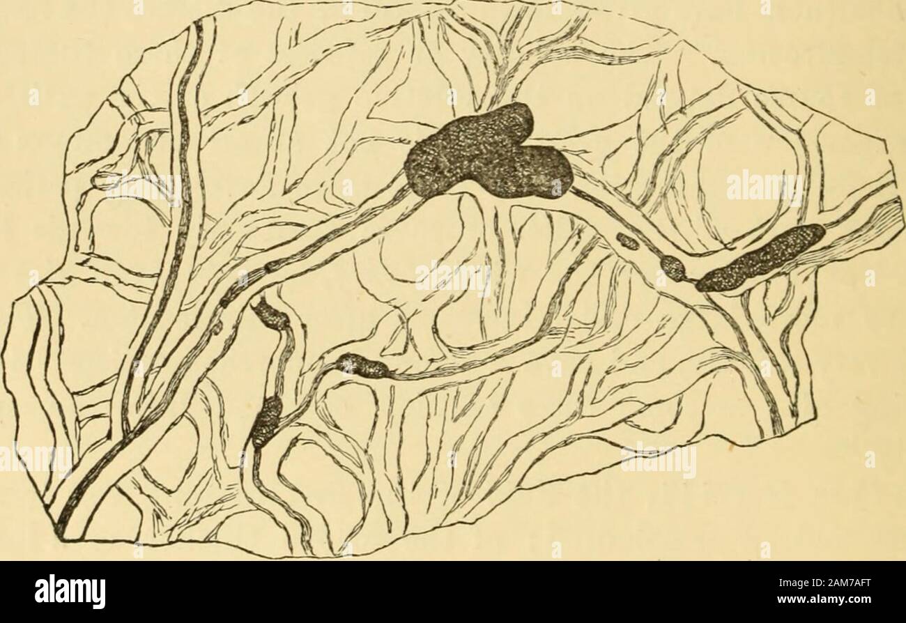 Les maladies de l'ovaires : leur diagnostic et traitement du kyste alls ..Cette tumeur était huit pouces de long, six pouces de large, et fromone et un demi à deux et un demi-pouce de profondeur. Il consistedof, beaucoup de tissu ovarien des mailles à pourvoir withlardaceous-, certains subissant la dégénérescence graisseuse loculi,et d'autres personnes devenir purulent. Dans la plus proche loculi thelarge sac la paroi interne avait cédé la place, et les projections de caillot comme une masse fungoid, easilybroken vers le bas avec le doigt, et se forme en shredsand granules. La membrane muqueuse de cette partie de l'largec Banque D'Images