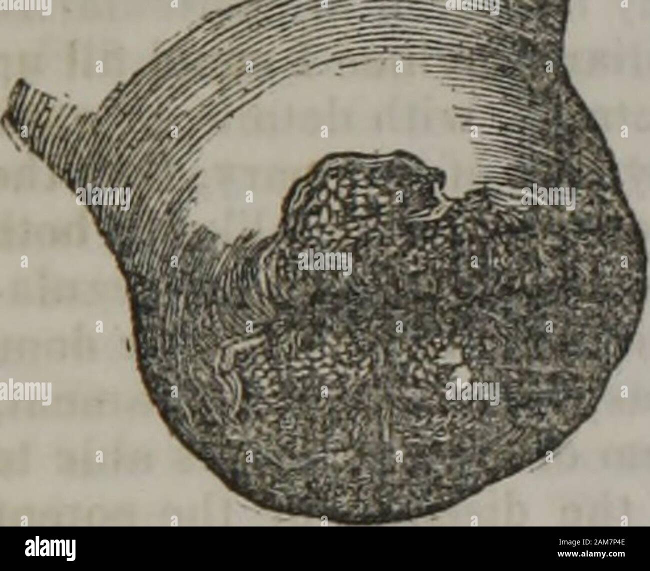 verrues génitales légères chez les hommes