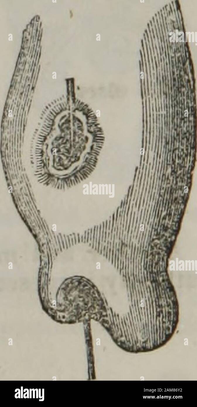 verrues génitales légères chez les hommes