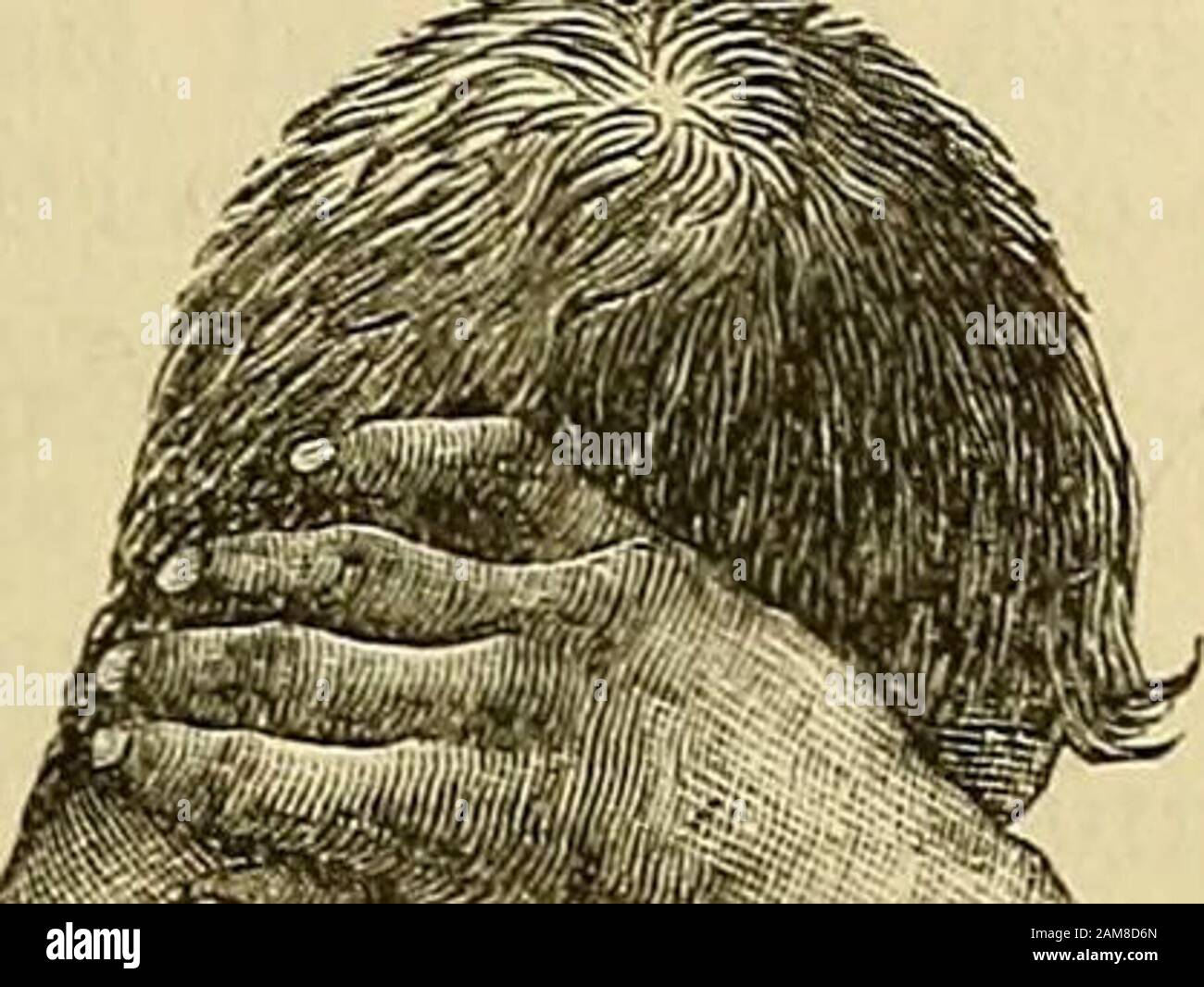 Un système de chirurgie . Fig. 41.- -bras lié Au Côté par Contraction d'un Soreafter large Burn. MALADIES DU GIOATBIGES. 231. Cicatrisation de la peau de la plaie greffée selon la méthode de Thierschs employée (page 117). 2. Cicatrix douloureux.—Où nous devons faire avec les analgésiques, la cause est généralement l'implication des nerfs dans la passation des tissus fibreux et la conséquence de l'apparition de la quantité d'acertain de névrite; et le meilleur remède est de disséquer l'awaythe cicatrice complètement et employer greffage cutané immédiat. 3. Cicatrix contractant, — Lorsque nous avons des contractingcicatres, le cicatrix shou Banque D'Images