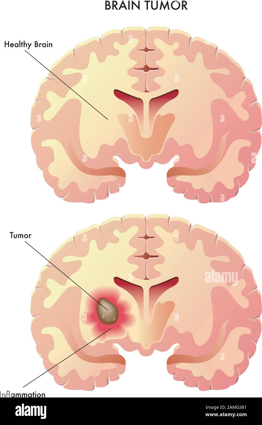 Illustration médicale des effets de la tumeur cérébrale. Illustration de Vecteur