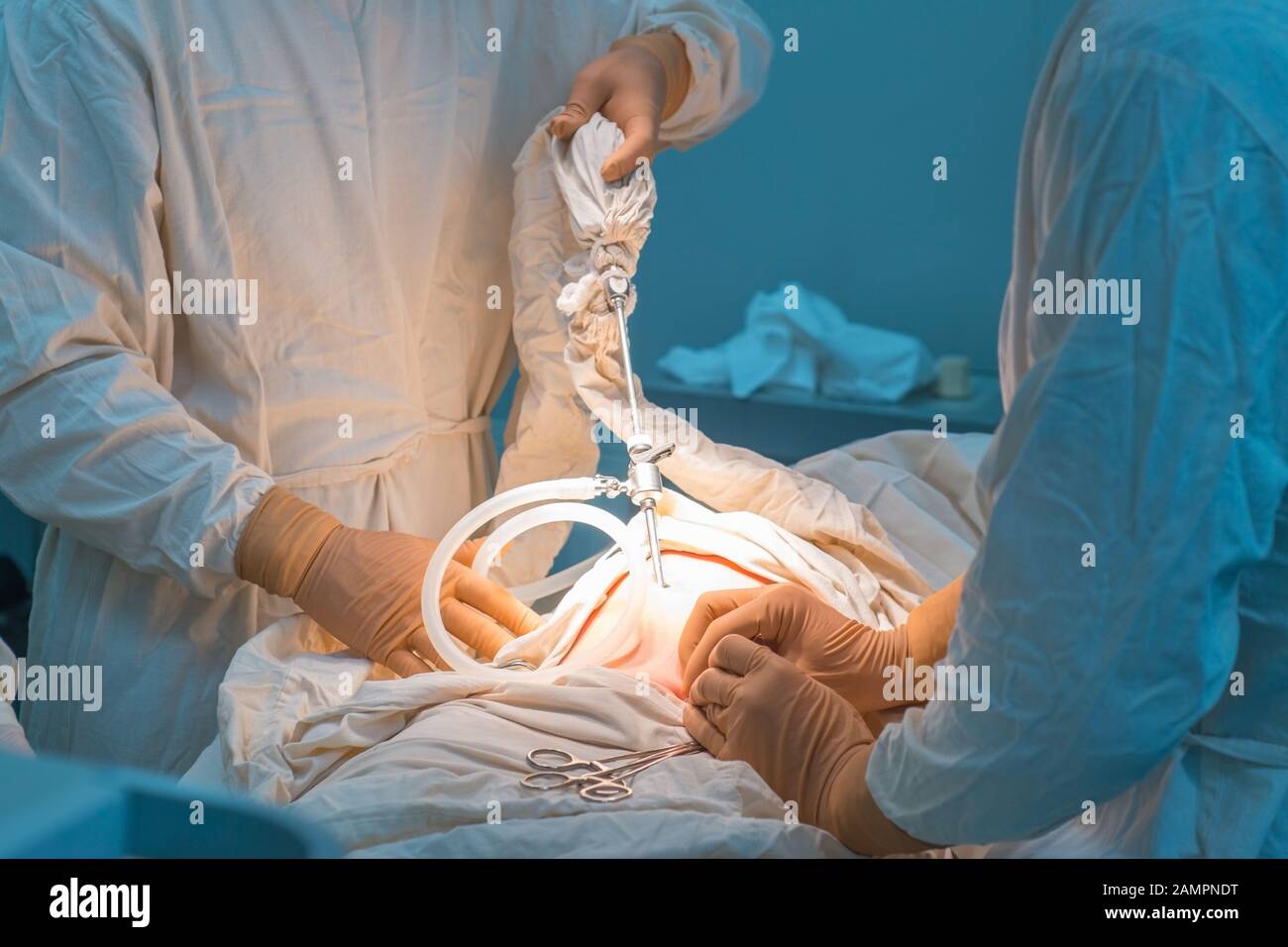 Close up de la chirurgie laparoscopique dans une salle d'opération stérile. La suture percutanée de l'anneau intérieur SRRJ. Chirurgiens et son assistant exécuter la chirurgie Banque D'Images