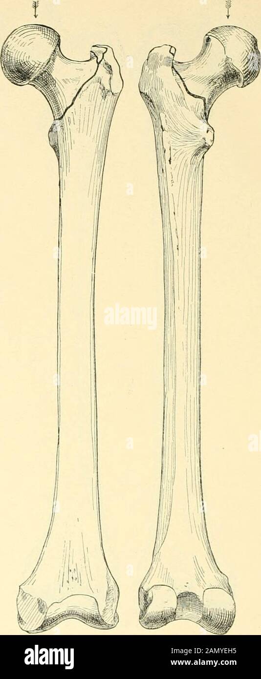 Beiträge zur Kenntniss einiger praktisch wichtiger Fracturformen . Fig. 114. Fractura colli femoris subcapitalis mit Fractura pertrochanterica durch Sehlag miteinem eisernen Hammer auf den Troehanter Major (-&lt;*R 1»-). Y-Fractur. 220 —. a. Fig. 115. b. Fractura colli femoris intertrochanterica durch Schlag mit dem Hammer auf il-a Fémur- knpf vuii oben elle. Typische Form der extracapsulären Schenkelhalefractur. 221 Banque D'Images