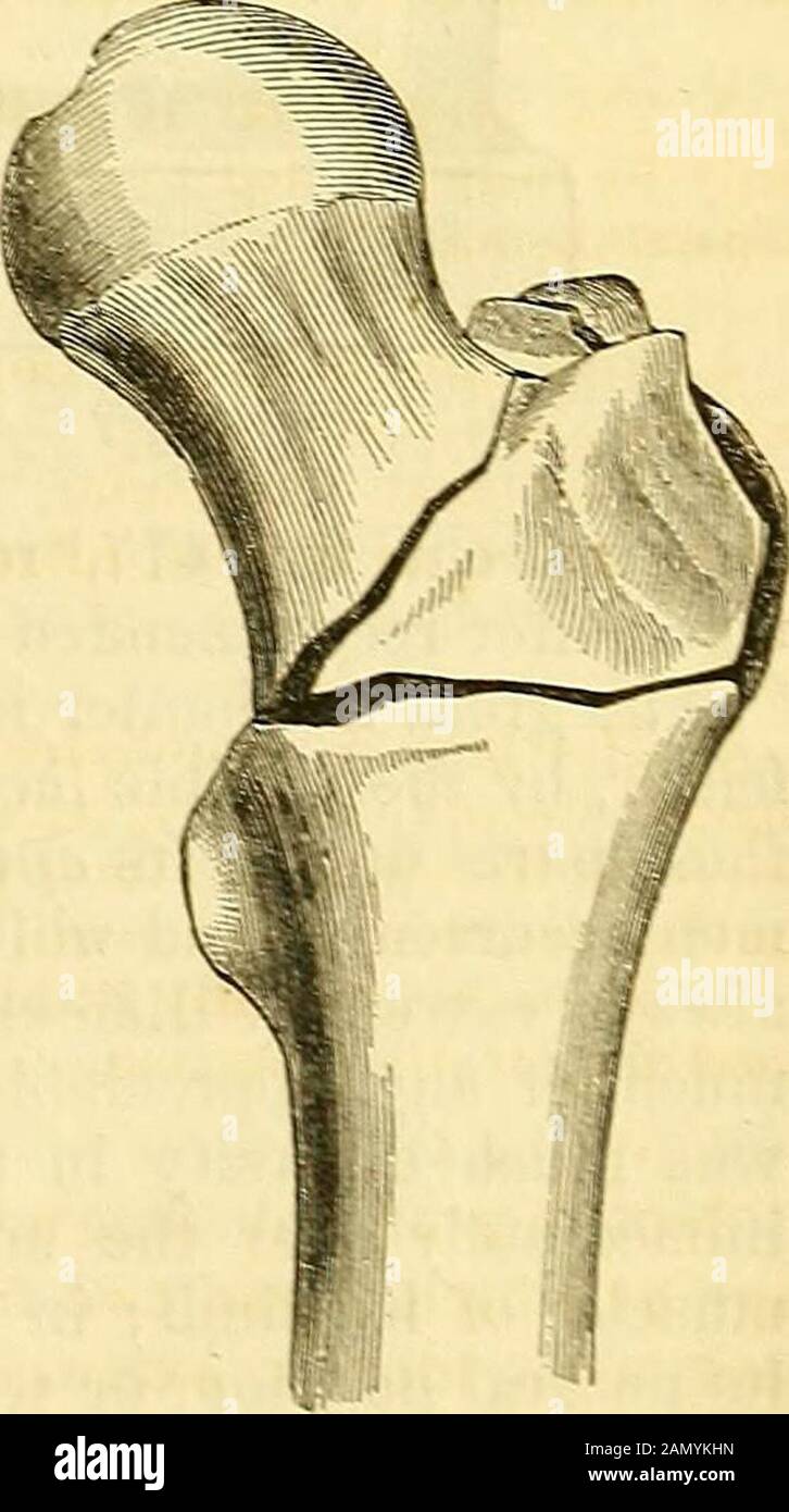 Un système de chirurgie : pathologique, diagnostique, thérapeutique et opératoire . coup, ou coup de pied, briser le trochanter dans la direction oblique d'en haut vers le bas. Thefracture est parfois comminée, le trochanterétant brisé en plusieurs morceaux, de forme irrégulière de sizeand, les fta2:ments gravant sous les doigts comme un certain nombre de morceaux de chine. Il peut également être bécomlivre, bien que, en général, il est non accompagnépar n'importe quelle blessure des parties molles. Les symptômes de fracture du grand trochanterare généralement bien marqués, le plus important con-siting de l'éversion du membre, avec la séparation ofth Banque D'Images