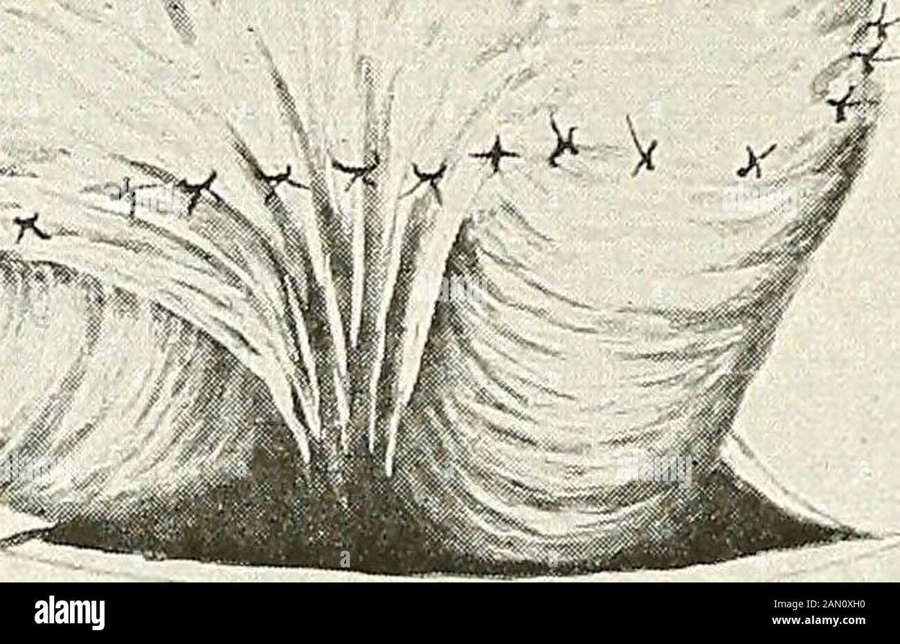 Blessures par balle : comment elles sont infligées : leurs complications et leur traitement . Montre l'intestin denudé et lacéré dans l'affaire Thornburgh. S'est produit dans la pratique du Major R. W. Thornburgh, U. S. A., assues: Privé William Ummack, Co. H, 30 U. Infantry, récemment entré à l'hôpital général Letterman, San Francisco, Californie, pour la blessure par balle de l'abdomen auto-infligée. L'arme usedwas le fusil de magazine de calibre réduit de l'armée américaine chargé d'une cartouche pleine charge. Entrée de la plaie de 3 x 2 cm de diamètre, située à 5 252 BLESSURES PAR BALLE de cm. À gauche et de 2 cm. Au-dessus de l'ombilic. Blessure de sortie Banque D'Images