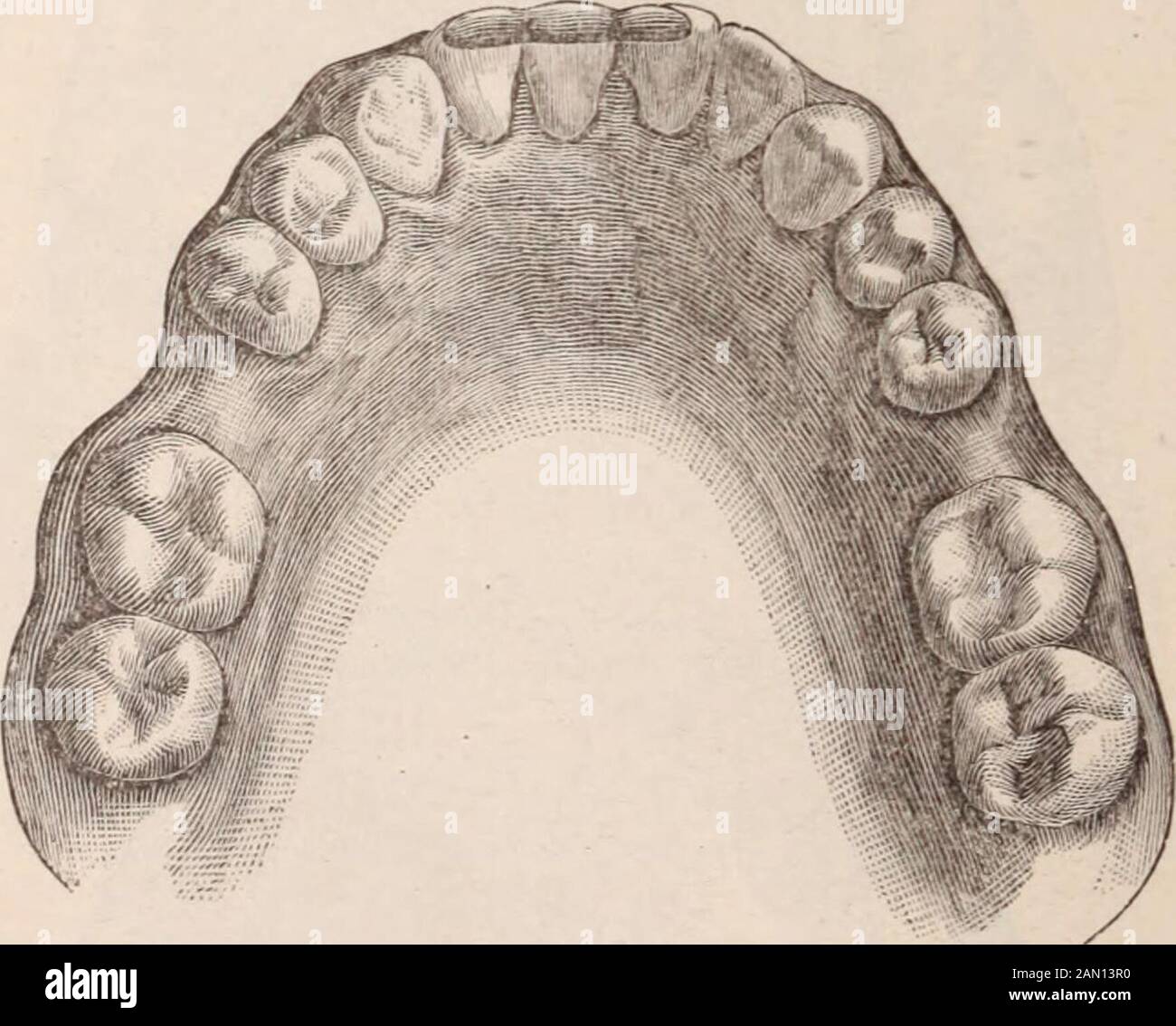 Cosmos dentaires . illustré sur la Fig. 6, B. l'espace entre le centre gauche et lateralwas le résultat des patients qui ont retiré la attelle et l'abstentingelle jusqu'à trop tard pour modifier la position de la dent. Son mauvais positionnement, cependant, n'est pas de tout moment. Fig. 7, C, représente une jeune bouche de ladys. Efforts pour faire pivoter la Fig. 8, F.. Les centrals ont entraîné la mort des pulpes et la sorption partielle des racines. Ils ont été enlevés, leurs douilles s'agrandissent et s'approfondissent, et deux belles dents, contraintes, placées en position. Abicuspid a ensuite été implanté où une plaque avait été wornpendant des années. Banque D'Images