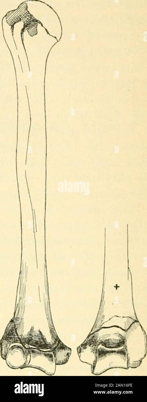 Beiträge zur Kenntniss einiger praktisch wichtiger Fracturformen . Fig. 62. Fracturasupracondylicahn foreirter Hyper-extension unteren Endes gegen diediaphyse. [Tension Fractur.) Fig. 63. Fractura supracondylica durch Fall einer•js Kilogramm schweren £isenkugel aufdie Rückfläche des unteren üuiuerus- 1 ri11*? 1 &gt; bei im rechten Winkel leetirtemVorderarm und nufgestützter Hand.Exteiisionsfractur.; — lo3 — Aus wärt s-rotation. Biegung des Humerus im Sinn der Flexion bei flxirten Con- dylen. Banque D'Images