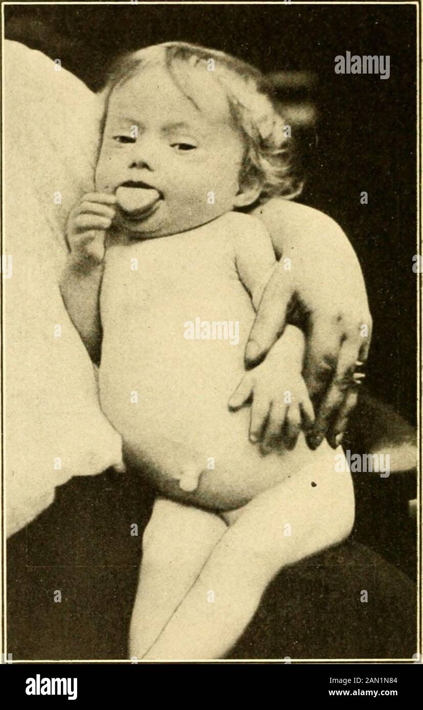 Diagnostic Et Traitement Modernes Des Maladies De L Enfant Un Traite Sur Les Maladies Medicales Et Chirurgicales De L Enfance Anf Fig 150 Goitre Kystique Au Cours Des Deux Dernieres Annees Patient 13 Ans Est