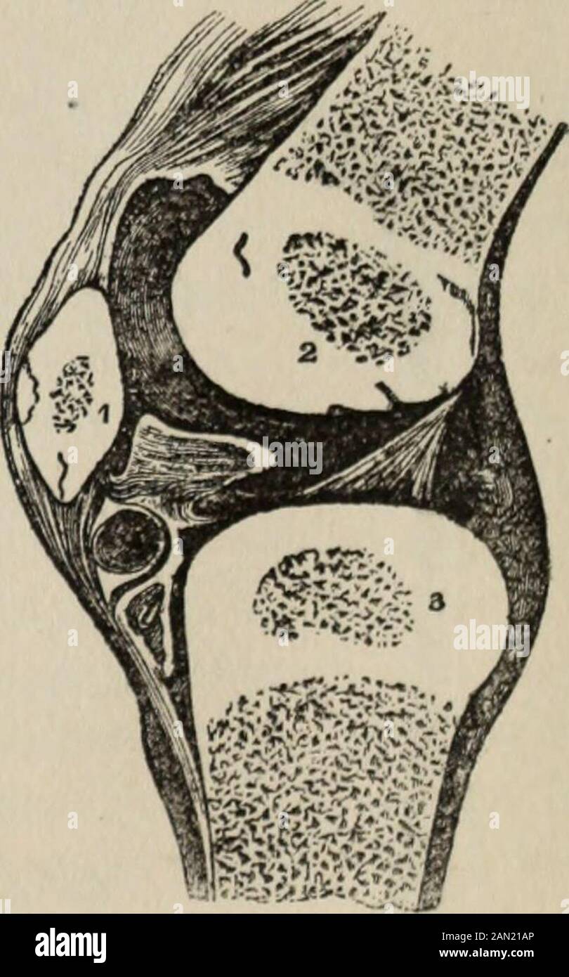 Connaissances en santé : une connaissance approfondie et concise de la prévention, des causes, Et les traitements de la maladie, simplifié pour l'usage à la maison . l'articulation du genou est asMall os plat triangulaire appelé theagenouilecap, développé dans le tendon à l'avant de la cuisse, sa surface postérieure faisant partie de l'articulation du genou.le squelette de la jambe se compose de deux os, le tibia et le fibula. Le tibia, ou os de jambe, est le plus fort et plus grand des deux; il a un arbre avec trois surfaces et des bords tranchants, une extrémité large, plate et supérieure qui a une tubérosité de chaque côté, l'extérieur avec une surface lisse à Banque D'Images
