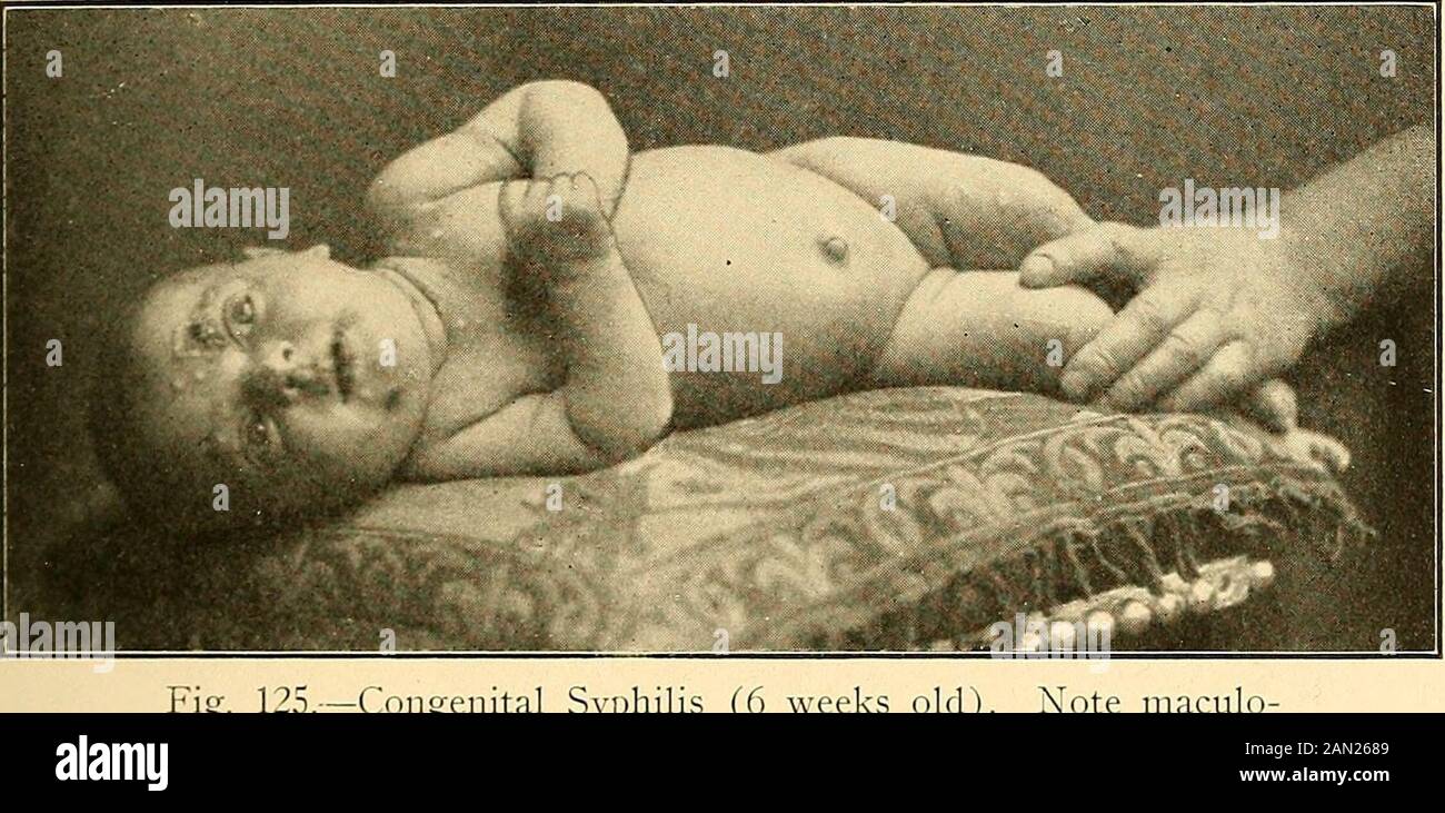 Diagnostic et traitement modernes des maladies de l'enfant; un traité sur les maladies médicales et chirurgicales de l'enfance anf . sang maternel (à tout moment pendant la grossesse). La grande majorité des embryons syphilitiques ou des fœtus sont avortés. Les rares qui survivent peuvent passer par le syphiliticprocess in utero ( syphilis embryonalis ou foetalis) et émerger intole monde soit mort ou dans une condition de crevette, rétréci, émaciée ordéfigurée (hydrocéphalie, spina bifida, etc.), et, comme l'arule, succomber peu après la naissance; ou le fœtus mav maintenir UNE SYPHILIS. 399 bon état de santé pendant l'intra- Banque D'Images