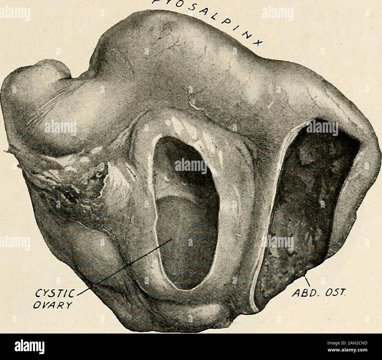 Gynécologie pour les étudiants et les praticiens . des tissus fibreux atrophie musculaire, et donc un vieux pus-sac peut se composer d'un mur épais, composé entièrement de tissu conjonctif sans un muscle trachéal. Le péritoine est généralement recouvert par des fibrinousadhérences, des granulations, et enfin par des laminae de tissu conjonctif épais. Il y A Aussi une péritonite pelvienne étendue, avec des adhésionsà l'ovaire, au dos de l'utérus, au ligament large, et au rectum. Les opus-sacs tubaires peuvent communiquer entre eux avec un abcès ovarien (voir Fig. 332), en fait les structures adnexal peuvent être Banque D'Images