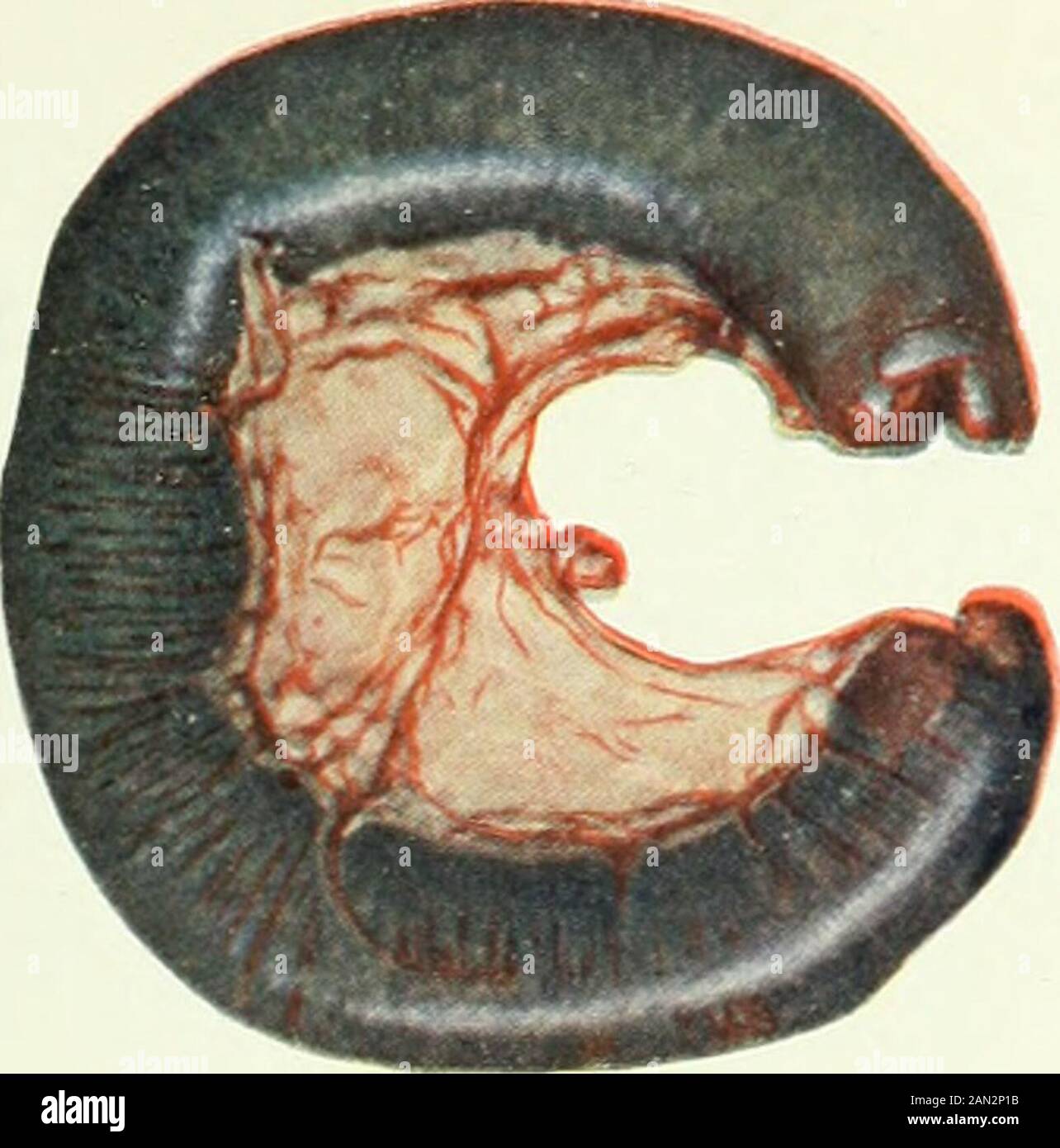 Le journal médical britannique . apparaissent gangrène est considéré comme mostAdvanced dans les patches de Peyers. Si la boucle est remplie en onlypartie de contenu, les changements sont plus lents indeloping, mais sont pratiquement les mêmes. 4. Lorsque la boucle est tillée avec une émulsion de bactériagnoiement de caecp.l contenu aucun changesare précoce vu, aud si l'animal est tué quarante-huit heures de slater la boucle présente une apparence presque normale et ne montre aucun signe d'inflammation ou de gangrène. Après avoir observé une longue série de telles expériences, on a profondément impressionné le changesgess morbides rapide qui s'ensuivent lorsque feca Banque D'Images