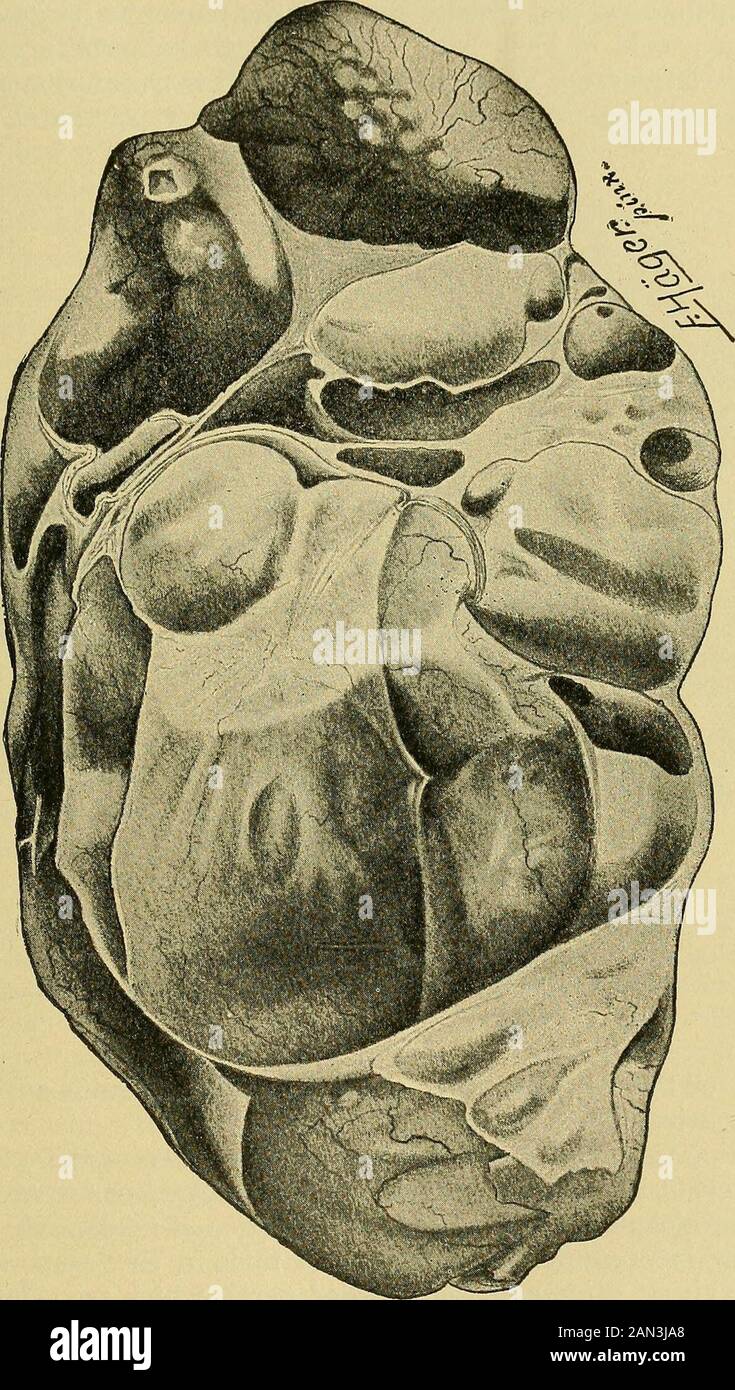 Pathologie et traitement des maladies des femmes . ., épithélium anon-cilié sécrétant un fluide stringy contenant de la pseudomucine, l'autre épithélium cylindrique cilié avec une sécre liquide mince. Toutes les connaissances de l'étiologie veulent comme mentionné ci-dessus. Les Différentes Formes De Littérature De Newgrowth Épithélial : Voir Pfannenstiel Dans Veits Handbuch Der Gynakologie, Vol. Iii Wies-baden, Bergmann, 1899. A. Martin, Handbuch der Adnexorgane, vol. II Leipzig-,Georgi, 1898. Frommel, Jahresber, iiber Geb. U. Gyn., 1899-1906. Le Cystadenoma Glandulare Multiloculare Pseudomucinosum Lorsque Le Banque D'Images