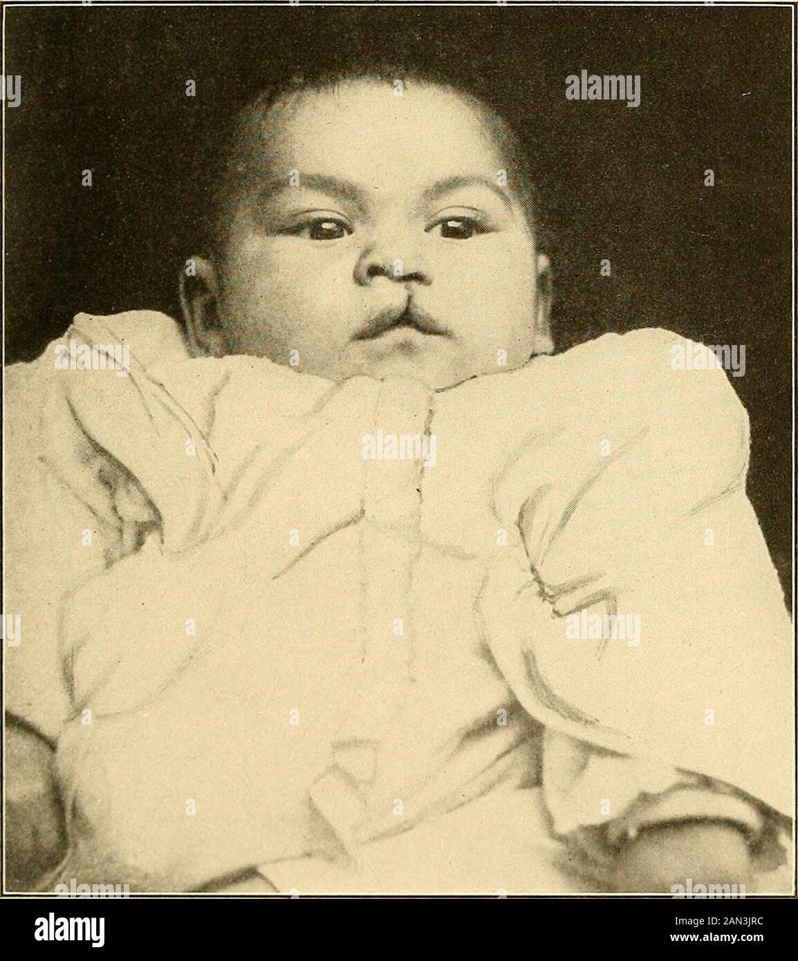 Diagnostic et traitement modernes des maladies de l'enfant; un traité sur les maladies médicales et chirurgicales de l'enfance anf de l'enfance . aussi haut que le couvercle inférieur. 4. Transverse (Macrostoma), en raison de la patency de la rainure entre le processus maxillaire supérieur et la voûte prébranchiale (mandibula).Occasionnellement, des fistules et des fissures sont observées dans le pont du nez et de la lèvre inférieure.traitement! Détails du traitement le lecteur est appelé livres de texte sur la chirurgie. FENTE PALATINE (PALATUM FISSUM, PALATOSCHISIS). Elle est due à une Union défectueuse des processus du bon supérieur et du bon palais Banque D'Images