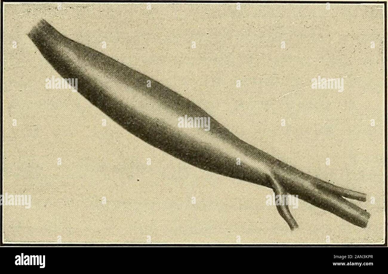 Maladies nerveuses organiques et fonctionnelles; un livre de texte de neurologie . sont impliqués. Lorsque le type de bras inférieur est isprésent, les nerfs cervicaux des septième et huitième sont affectés. Duchenneshowed que la pression vers l'arrière sur le côté du cou est responsable de compresser ces deux nerfs contre la lamina de la sixième cervicalvertèbre. ERB a montré qu'il est possible par un examen attentif de trouver une tache de deux centimètres au-dessus de la clavicule, à l'arrière du bord extérieur du muscle sternomastoïde, correspondant au point d'émergence du sixième nerf cervical entre les scaleni, à quel point l'irritation par le Banque D'Images Maladies nerveuses organiques et fonctionnelles; un livre de texte de neurologie . sont impliqués. Lorsque le type de bras inférieur est isprésent, les nerfs cervicaux des septième et huitième sont affectés. Duchenneshowed que la pression vers l'arrière sur le côté du cou est responsable de compresser ces deux nerfs contre la lamina de la sixième cervicalvertèbre. ERB a montré qu'il est possible par un examen attentif de trouver une tache de deux centimètres au-dessus de la clavicule, à l'arrière du bord extérieur du muscle sternomastoïde, correspondant au point d'émergence du sixième nerf cervical entre les scaleni, à quel point l'irritation par le Banque D'Images