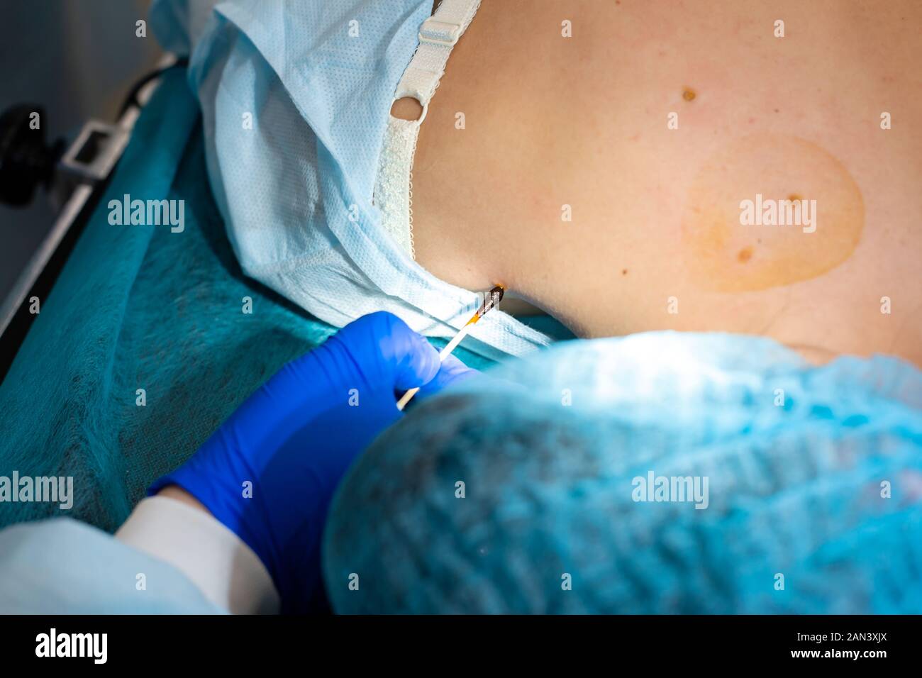 Close-up chirurgien burns une taupe sur le dos du patient. Procédure de chirurgie de déplacement de taupe. Banque D'Images