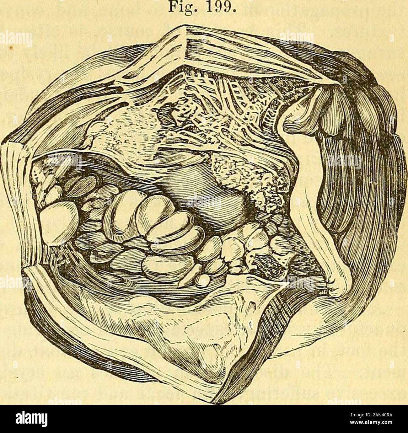 Un système de chirurgie : pathologique, diagnostique, thérapeutique et opératoire . te cure est effectuée. L'opération par incision est parfois pratiquée dans ces accumulations dropsicales ; mais comme elle n'est pas seulement grave, mais susceptible d'être suivie par une inflammation violente, parfois sérieusement impliquant un joint voisin, il devrait, dans mon jugement, être abandonné. 4. Intermélangé avec le fluide décrit ci-dessus, ou se produisant par eux-mêmes, il CHAP. II. APONEUROSES. 605 sont occasionnellement des concrétions lâches, d'une consistance fibreuse dense, fibro-cartilagineuse ou voiture-tilagineuse, qui, de la singulière Banque D'Images