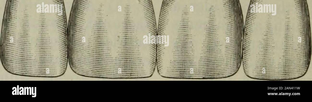 Le cosmos dentaire . Dorsaux ordinaires avec facings et piliers avec calotte. Fig. 7.. Pont fixe. Amovible et mixte. Le premier est le plus impliquant, et quand set est comme le type ordi-nary de pont dans ne pas être remov-able. La seconde forme introduit une nouvelle fonctionnalité, dans ce tout, mais les couronnes porce-lain est amovible à volonté. Bridgesof le troisième groupe implique simplement l'annonce de toute autre couronne ou métallurgie à l'une ou l'autre des formes précédentes. Les méthodes de travail ne se différencient pas de celles qui sont actuellement employées, mais bien sûr certaines variations sont nécessaires. Doivent être utilisées, en raison de Banque D'Images