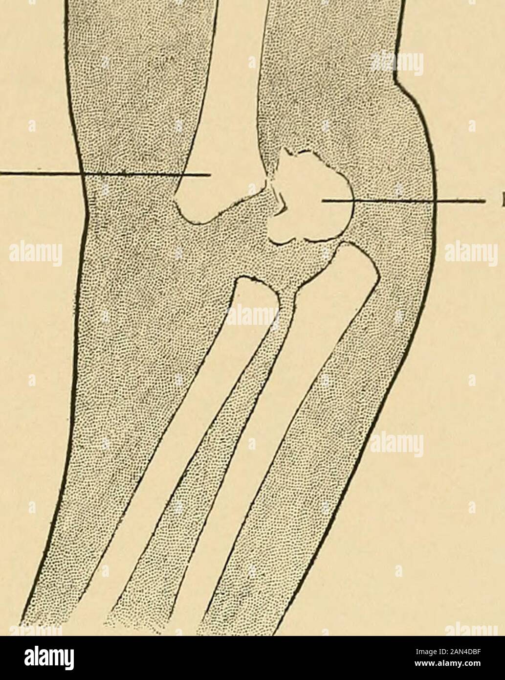 Le traitement des fractures . Capitellum. Fig. 210.—Identique à la figure 208, après réduction. Vue latérale. Splintseen interne à angle droit en position (tracé de rayons X). L'épicondyle externe, le capitulum et la trochlea. Les centres d'ossification de Theseseseseparate s'unissent vers la treizième année, et vers la dix-septième année ils rejoignent l'arbre de l'os. DIAGNOSTIC différentiel 173 L'épiphyse de l'épicondyle interne est entièrement séparée de l'épiphyse large, générale, inférieure et humérale. Le mert de l'humérus... Épiphyse. Fig. 211.—séparation de l'épiphyse humérale inférieure (tracé des rayons X) (Mas Banque D'Images