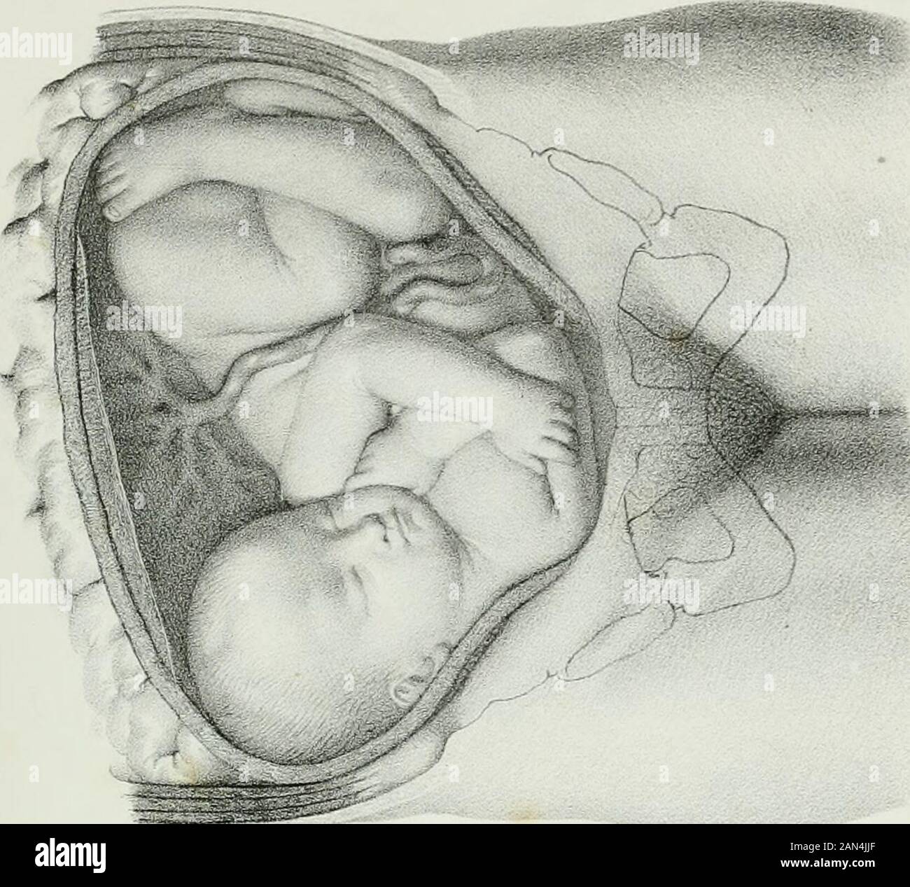 Atlas complet de tous les traités d'accuchements . ?- iih psiEraileBeaii. Il^ le!!ierc:sr. RENTATION DE LEPA. Banque D'Images
