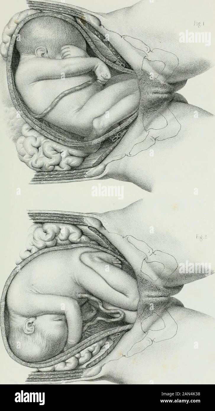 Atlas complet de tous les traités d'accuchements . ?Ri:,SENTA. GENOUX .70. ?- iih psiEraileBeaii. Il^ le!!ierc:sr. RENTATION DE LEPA. Banque D'Images