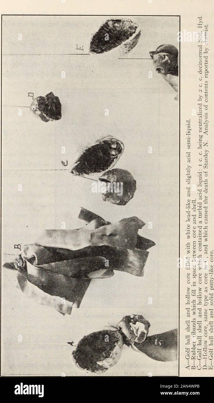 Journal officiel de l'ophtalmologie, l'otologie et de laryngologie . D. Rowland W... Balle de Golf 680 RurruRE dans la bouche et la mort en 30 heures. le lobe central droit, qui était la chose considérée comme une intervention étrangère coopérative. bodybefore L'œsophage a été corrodés dans streaksand la muqueuse de l'estomac d'en face le cardia avait disparu, leavinga dark zone corrodée de la taille d'un dollar et demi-themuscle exposant les tissus. La muqueuse gastrique a été généralement corrodés. Noforeign corps a été retrouvé dans les poumons. La pièce A est le larynx trachée--oesophage spécimen. La pièce B est la balle de golf qui a causé la base Banque D'Images