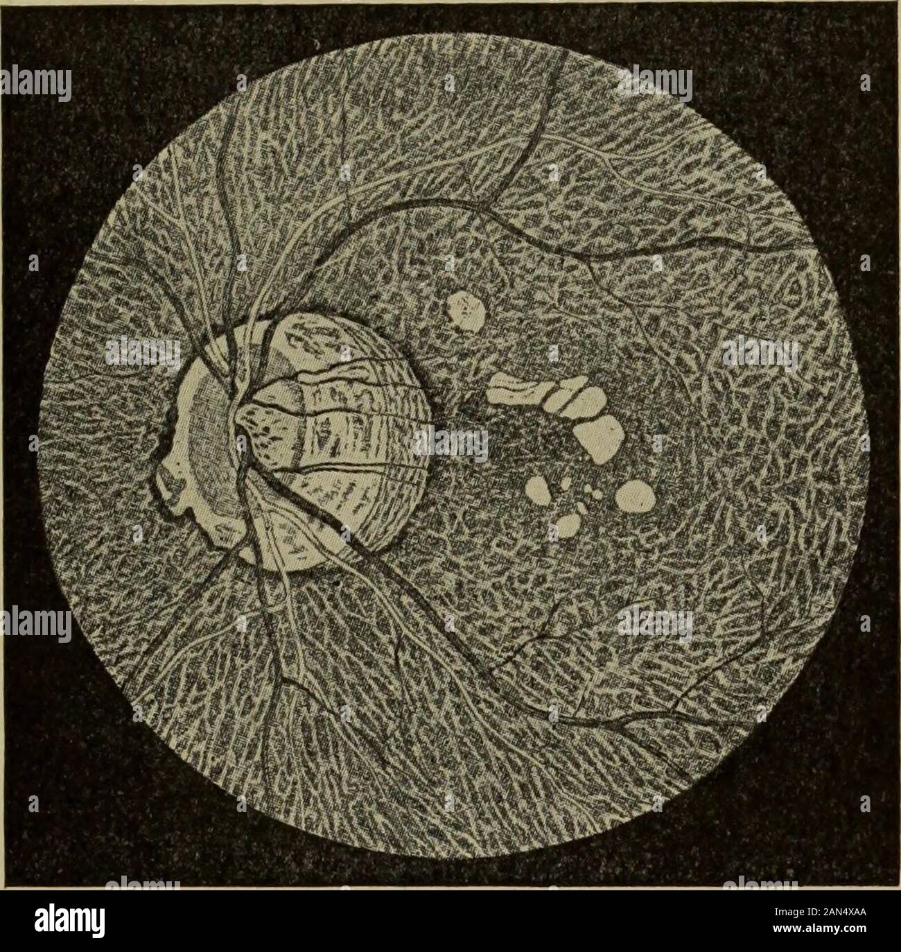 Text-book of Ophthalmology . le nerf. Les maladies de la choroïde 461 orifice pour le nerf optique, il n'est par la suite associé l'atrophie de la choroïde adjacent,qui permet désormais la sclérotique blanche pour montrer à travers. De cette façon, le surfaceon blanc du côté temporal du nerf optique augmente constamment de circonférence et thenextends le long de la frontières supérieure et inférieure du nerf à côté nez de cette dernière,jusqu'à ce que finalement la papille est entouré de tous côtés par une zone {circumpapillaryatrophy blanc, aussi appelé staphyloma annulaire-Fig. 201). Le nom est properlyapplied staphyloma à un renflement Banque D'Images