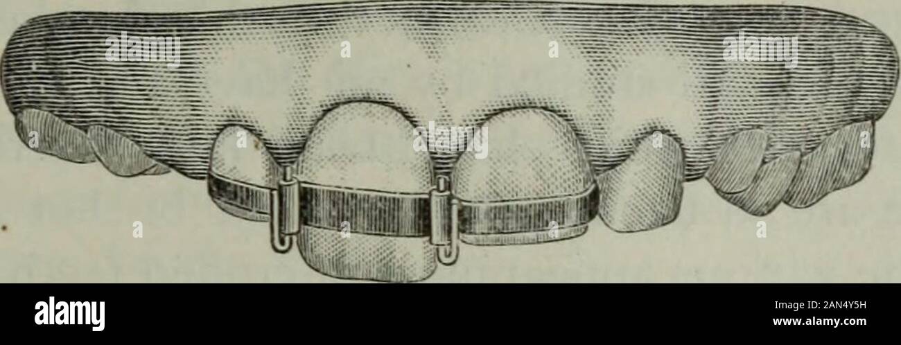 Le cosmos dentaire . Les dents à mouvement alternatif. Une étude. un temps suffisant il serait également le maintenir jusqu'à l'alvéole. Comme thegrowing incisives de chaque côté sont plus longs, ils seraient simplydraw les fils dans les tubes, mais encore donner la dent latérale de prions. Cette retenue est montré dans Fig. 19. Le 11 septembre, ces bandes de retenue-ont été prises off,la dent est fixe et immuable, la gomme à l'entreprise et en bonne santé. Sur le 24 septembre les dents est apparu comme indiqué en Fig. 20 ; thedifference en longueur des deux incisives centrales étant déjà muchless qu'il y a sur la 9 Banque D'Images