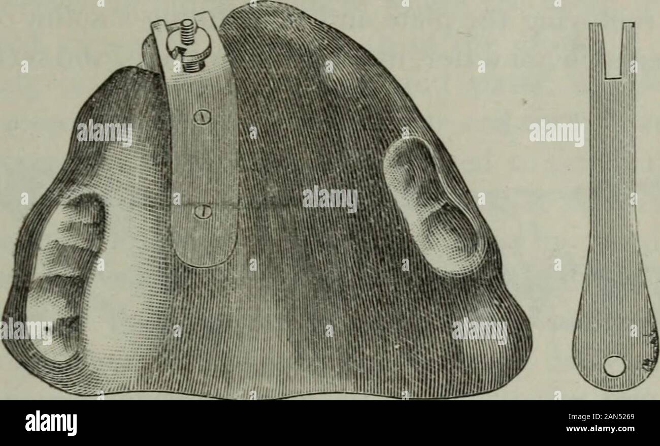 Le cosmos dentaire . Les dents à mouvement alternatif. Une étude. IO49 Le patient n'était pas encore onze ans, et toutes les dents ont été veryshort. Les trois autres étaient incisives ; les feuillus immatures cus-pids avaient été perdus depuis le début du traitement, alors que l'molarsafforded mais la moindre attache. Après avoir décidé d'newoperation, une vis plus fort a été bien fixés dans le canal et la plaque d'arubber effectués pour couvrir les molaires et les bords de l'threeincisors. Cette plaque a été épaissi au fil des molaires afin de tenir la mâchoire légèrement ouverte. Un large, une raideur de ressort, faite de platin Banque D'Images
