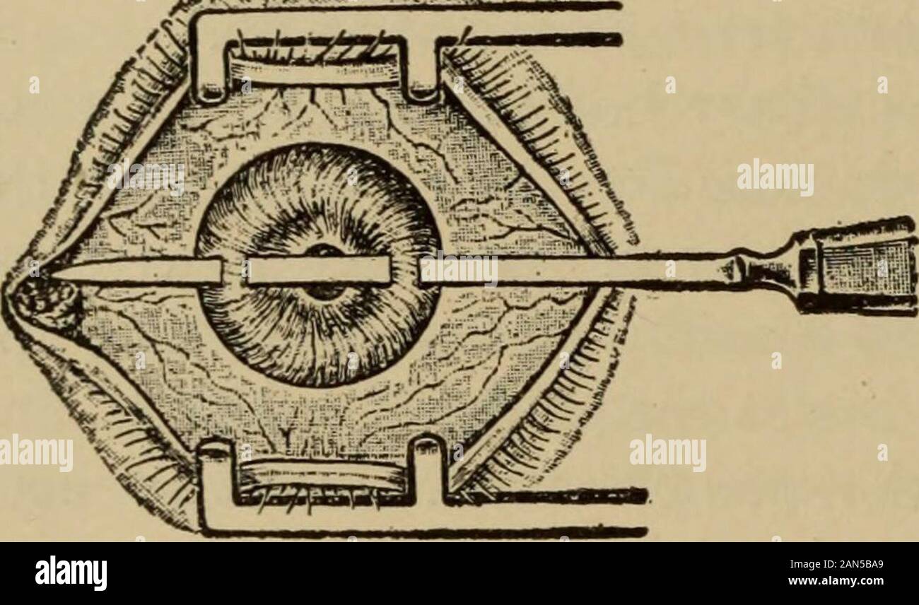 Text-book of Ophthalmology . la chambre postérieure, appuyer sur l'iris de l'avant. En forme de bosse un dépassement de l'iris est donc pro-duits, qui atteint enfin aussi loin que la cornée, tandis que l'élève est représenté par un cratère en forme de retrait de la marge pupillaire qui isattached à la capsule (Figs. 172 et 174). En conséquence de très beingso étirée, l'iris devient atrophiques. À cette condition le elevationof la pression intra-oculaire (glaucome secondaire ; voir paragraphe 459) est ajouté. Theincreased la dureté de l'œil peut être établie par la palpation ; le anteriorciliary sont veines dilatées Banque D'Images