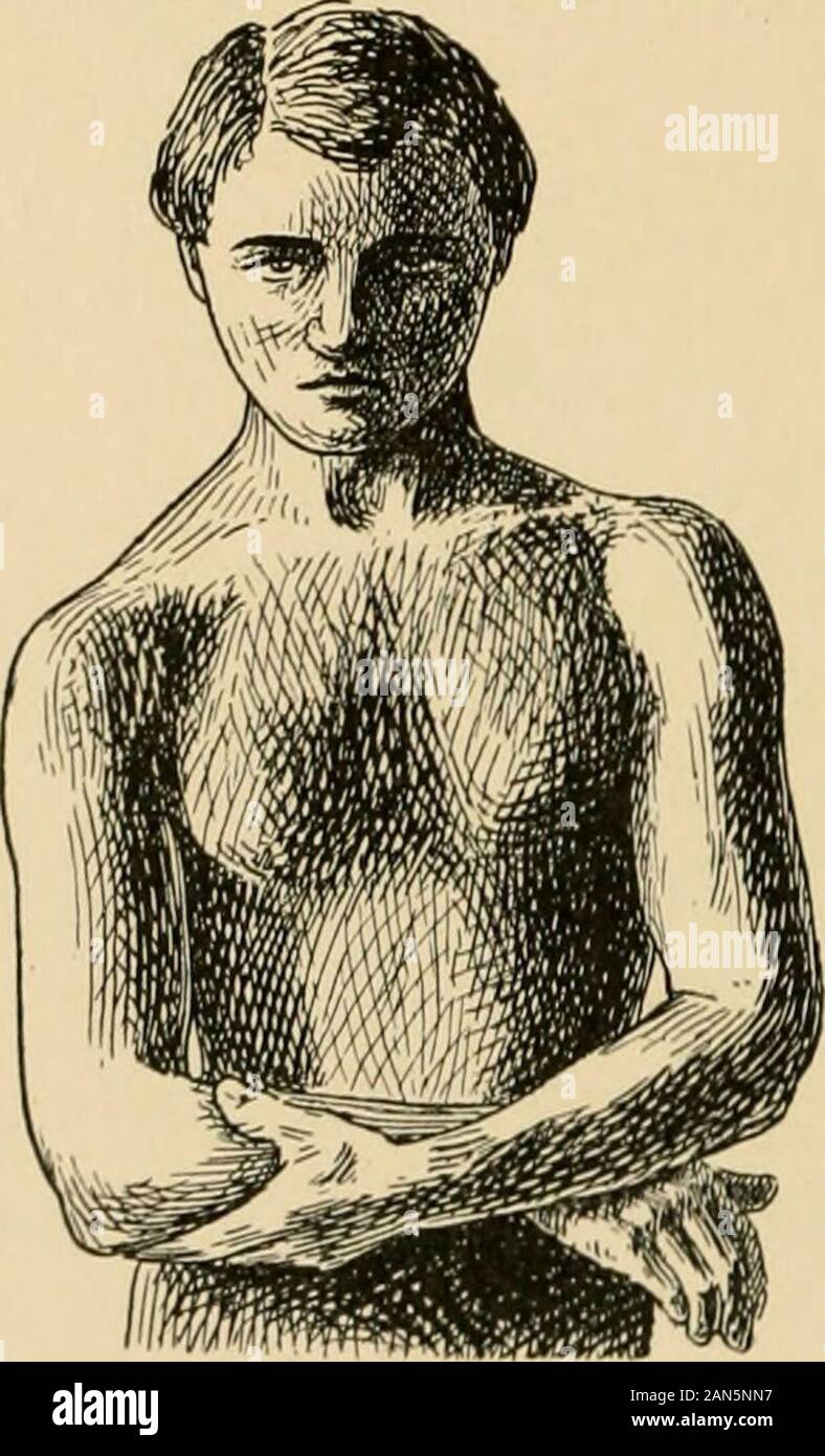 Le traitement des fractures . Kij ;. 119.-Cas : fracture comminutive de la clavicule gauche. Attitude caractéristique ; deformityvisible ; wired (Mixter).. ..-Attitude caractéristique d'une récente fracture de la clavicule droite. b c d Banque D'Images