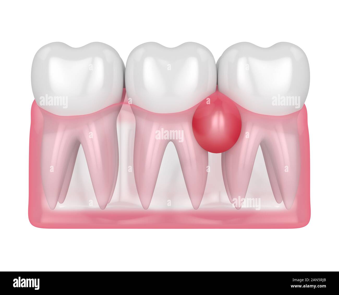 De rendu 3D dans les dents gencives avec kyste sur fond blanc. Problème dentaire concept. Banque D'Images