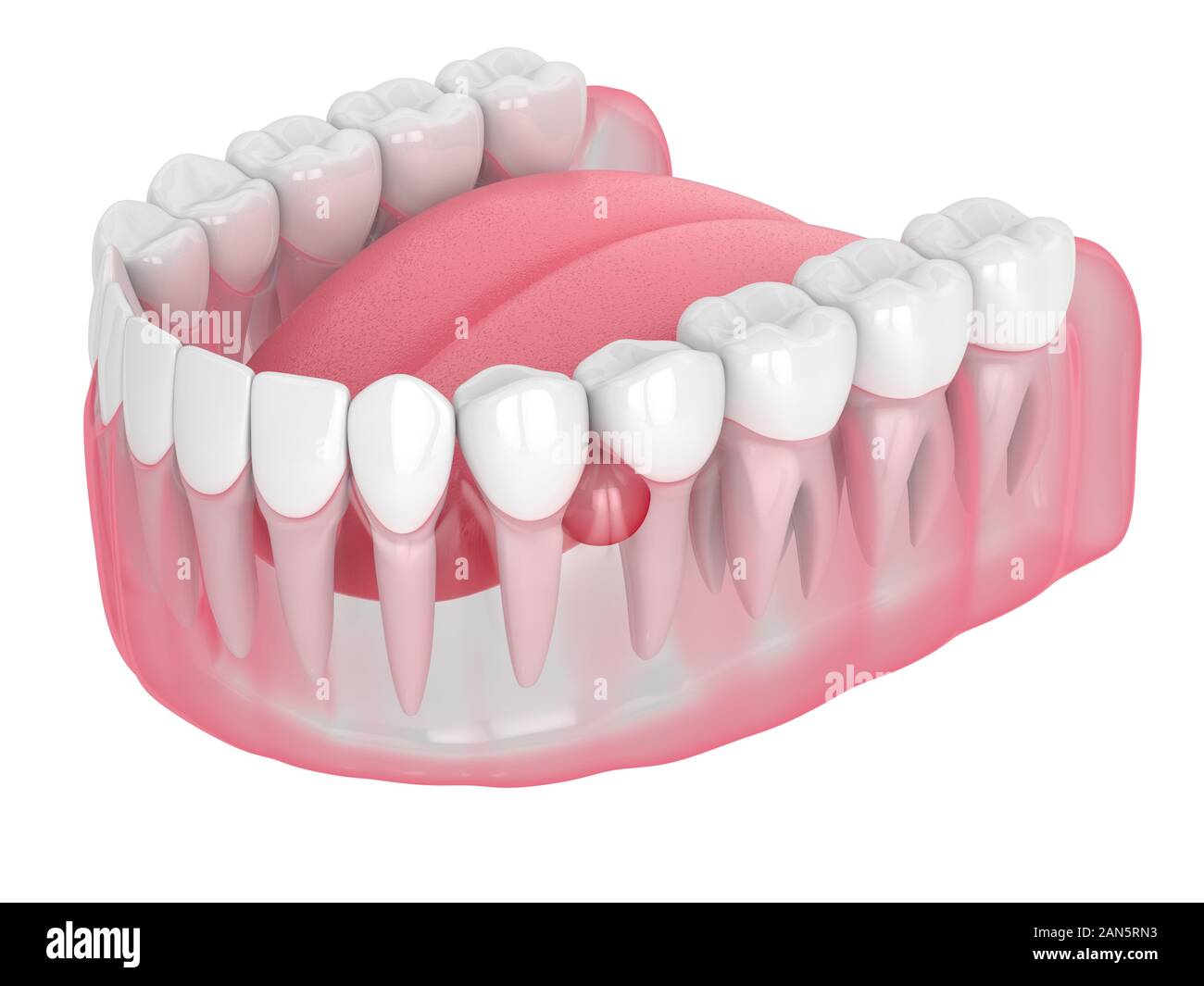 Mâchoire de rendu 3D et des dents avec plus de kyste fond blanc. Problème dentaire concept. Banque D'Images
