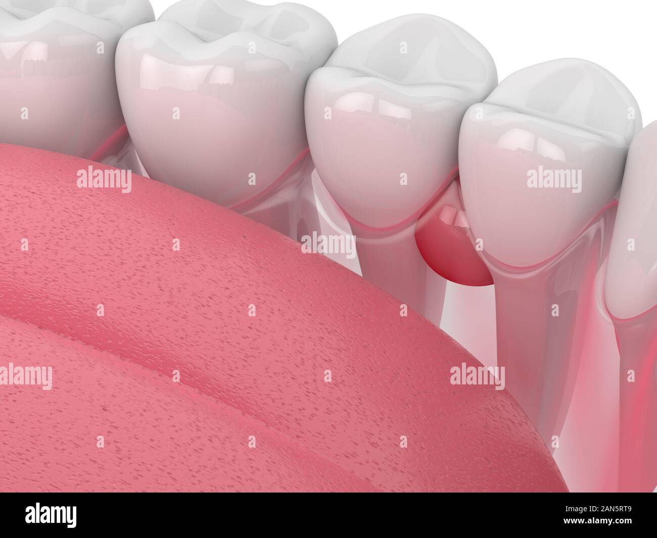 De rendu 3D dans les dents gencives avec kyste sur fond blanc. Problème dentaire concept. Banque D'Images