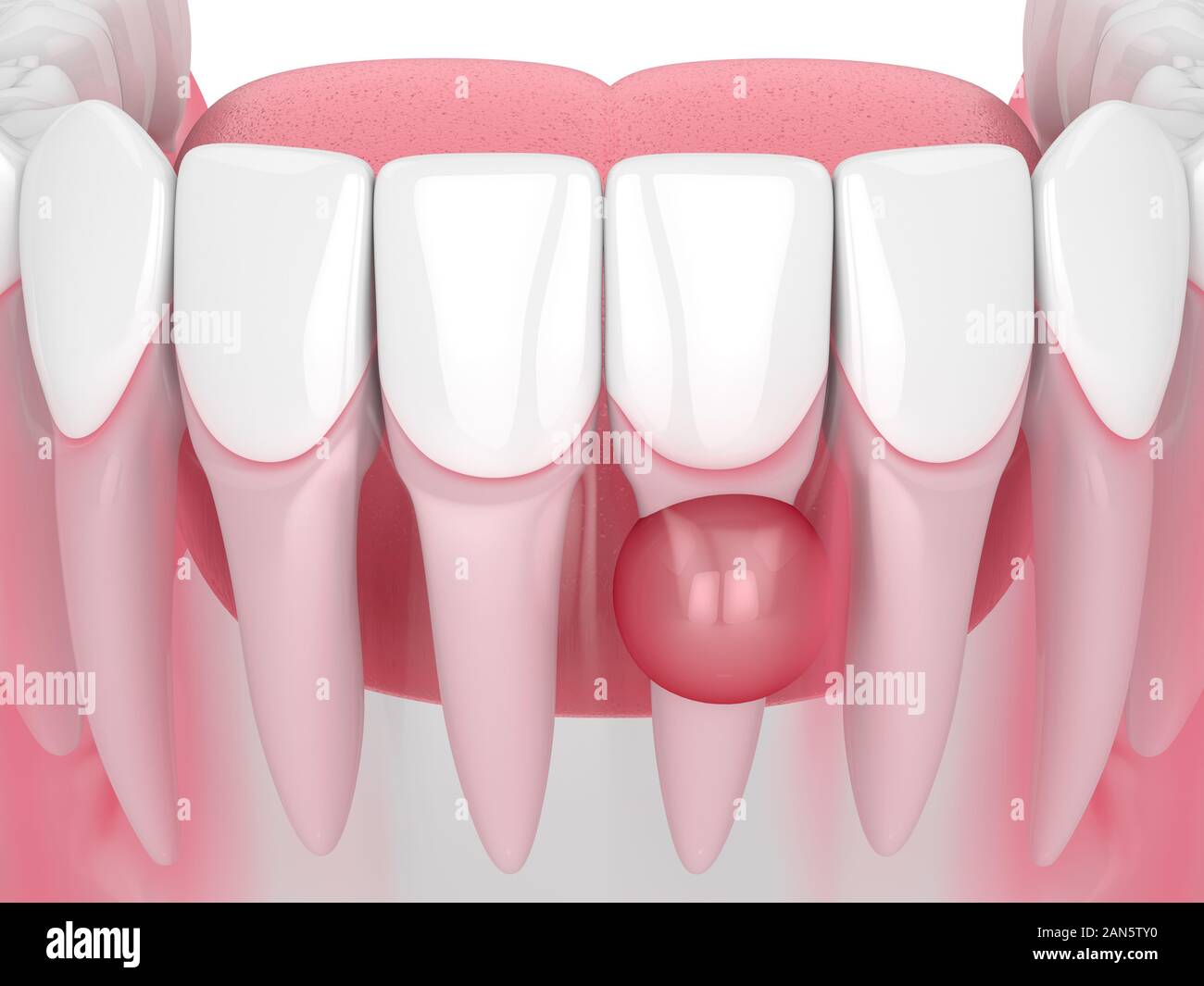 3D render of jaw avec kyste sur la racine des dents sur fond blanc. Problème dentaire concept. Banque D'Images