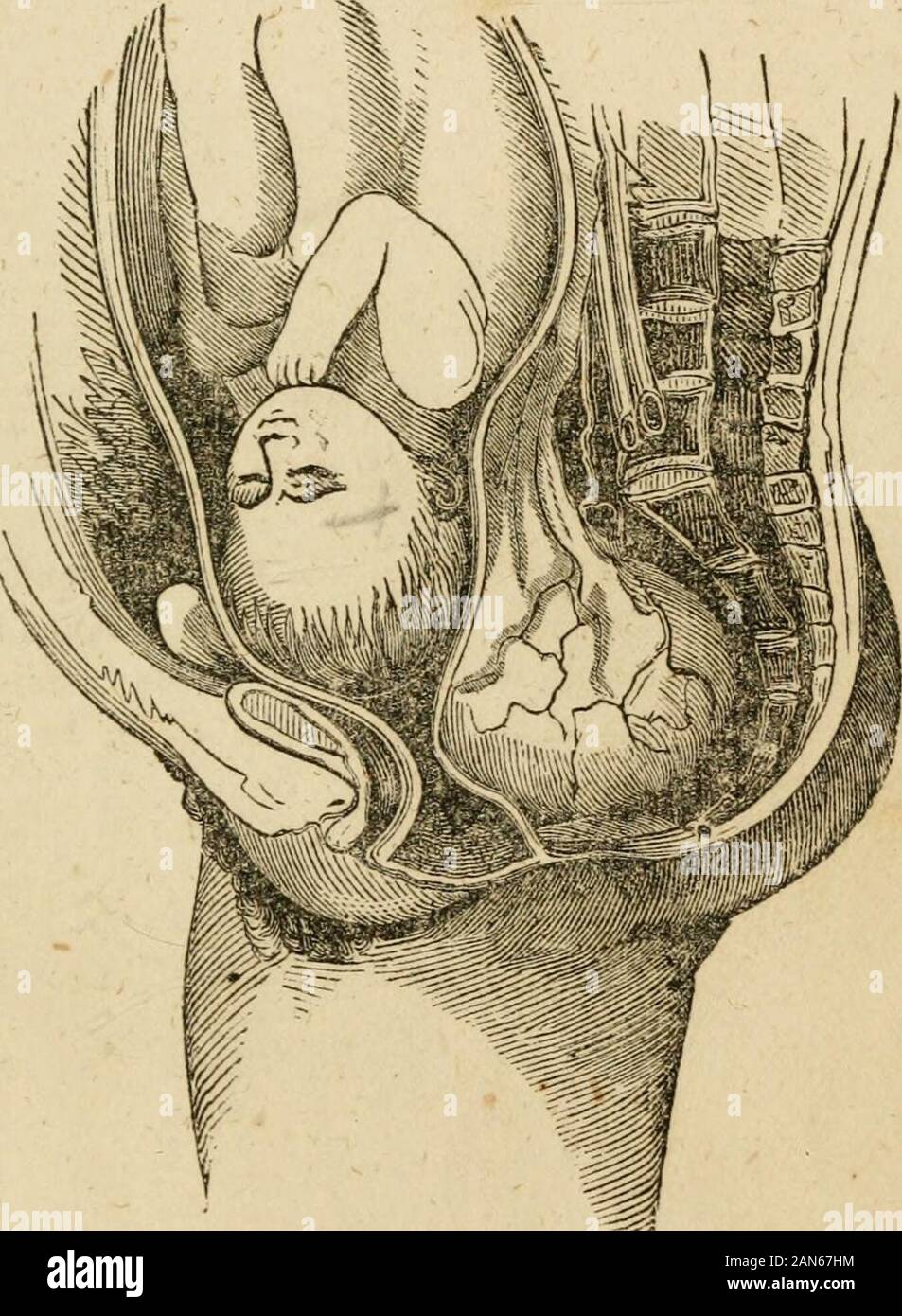 La Matrone d'entretien de sage-femme, et les maladies des femmes pendant la grossesse et à childbed .. . Peut être puncturedand laissa échapper leur contenu, de manière à les rendre moins.D'autres sont plus ou moins solides mais mayoften, mobile et être pris en charge au-dessus du détroit supérieur jusqu'après thechild est né. Lorsqu'ils sont si importantes qu'blockup le passage, et sont fixes ou ne peut pas becarried jusqu'à l'utérus, il n'y a souvent pas otherchoice qu'à les découper ou d'ouvrir le childshead ; la pratique étant déterminé par les circonstances du cas. Dans certains cas, le bladderitself, distendu avec l'uri Banque D'Images