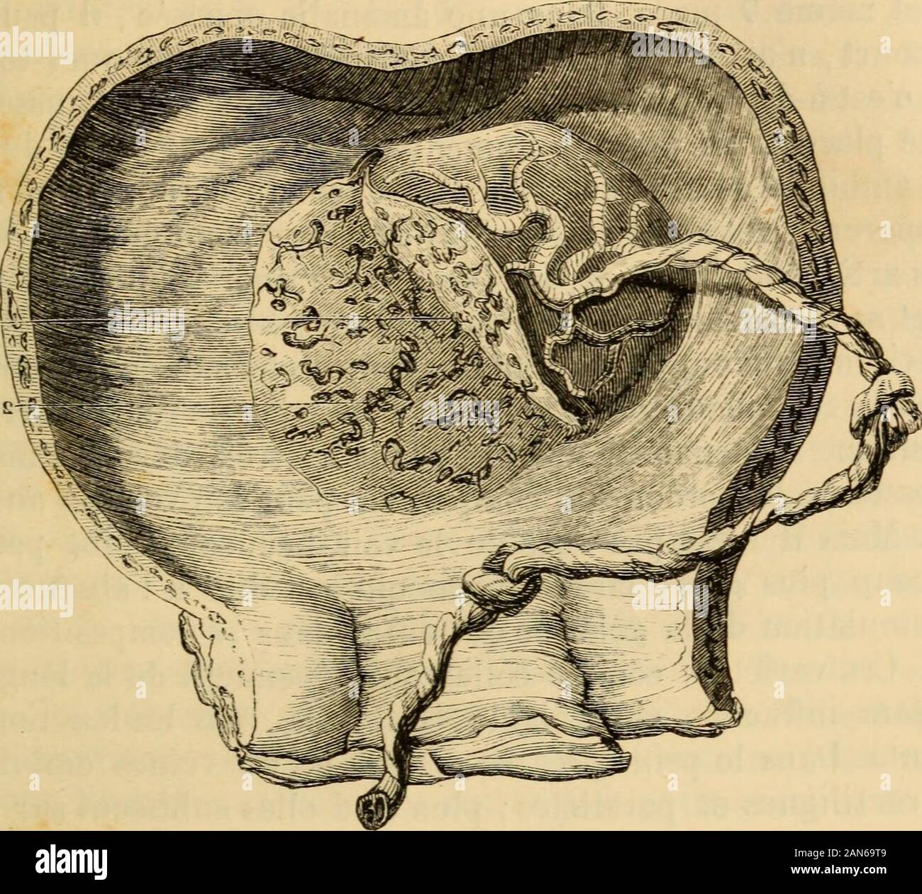Manuel des accouchements et des maladies des femmes grosses et accouchées : contenant les soins à donner aux nouveaux-nés . -Dominale : location chez lesanimauxoù etseeartent cesvaisseaux tribunaux sont plus^davantage, elle persists plus longtemps et ne disparaîtpas chez lel ovipares, où ils se répandent sur toute la face internedu chorion. Lallantoïde , contrairement à la vésicule ombilicale,te de dedans en dehors du cloaque vers le chorion : avec elleet sur elle savancent dans le même sens les vaisseaux iliaques-vitellin. M. Serres attribue une autre origine à lallantoïde : il laconsidère comme primit Banque D'Images