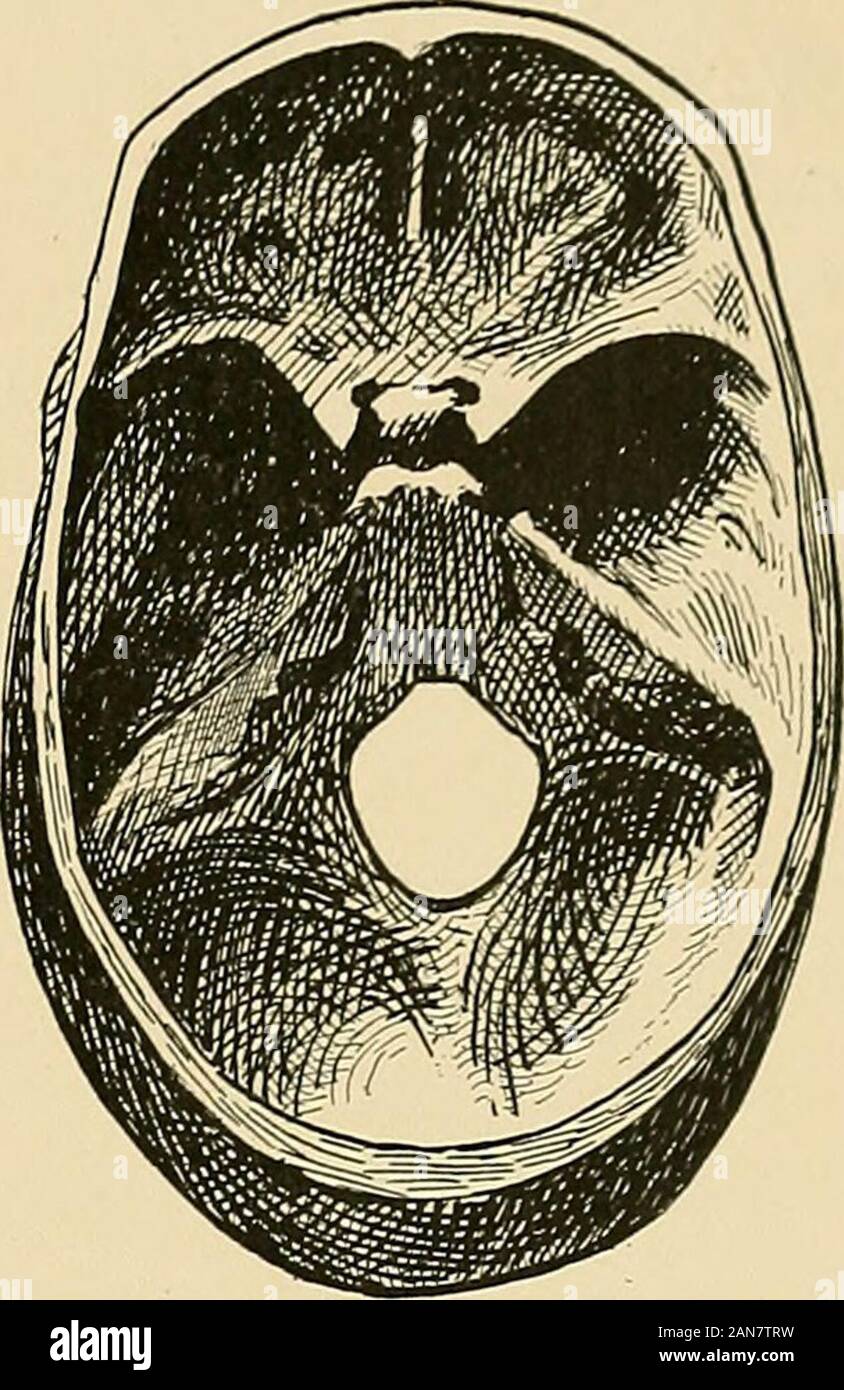 Le traitement des fractures . Fig. 19.-Fracture de la base du crâne, impliquant le moyen et postérieur gauche sur fossse (Warren, 5106). Musée méat conservateur. Un de ces signes est concluante à l'evidencethat la base du crâne est fracturée et qu'il n'alesion du cerveau. Les lésions du soin du visage (septième) andauditory (huitième) nerfs situées à l'intérieur des os. De même Lesionsare ont signalé du cinquième nerf, à cause de son lyingupon petrous la partie de l'os temporal. Subconjunc-tival hémorragie pouvant apparaître, en raison de l'itsway de travail du sang et de l'avant par la fi sphénoïdales Banque D'Images Le traitement des fractures . Fig. 19.-Fracture de la base du crâne, impliquant le moyen et postérieur gauche sur fossse (Warren, 5106). Musée méat conservateur. Un de ces signes est concluante à l'evidencethat la base du crâne est fracturée et qu'il n'alesion du cerveau. Les lésions du soin du visage (septième) andauditory (huitième) nerfs situées à l'intérieur des os. De même Lesionsare ont signalé du cinquième nerf, à cause de son lyingupon petrous la partie de l'os temporal. Subconjunc-tival hémorragie pouvant apparaître, en raison de l'itsway de travail du sang et de l'avant par la fi sphénoïdales Banque D'Images