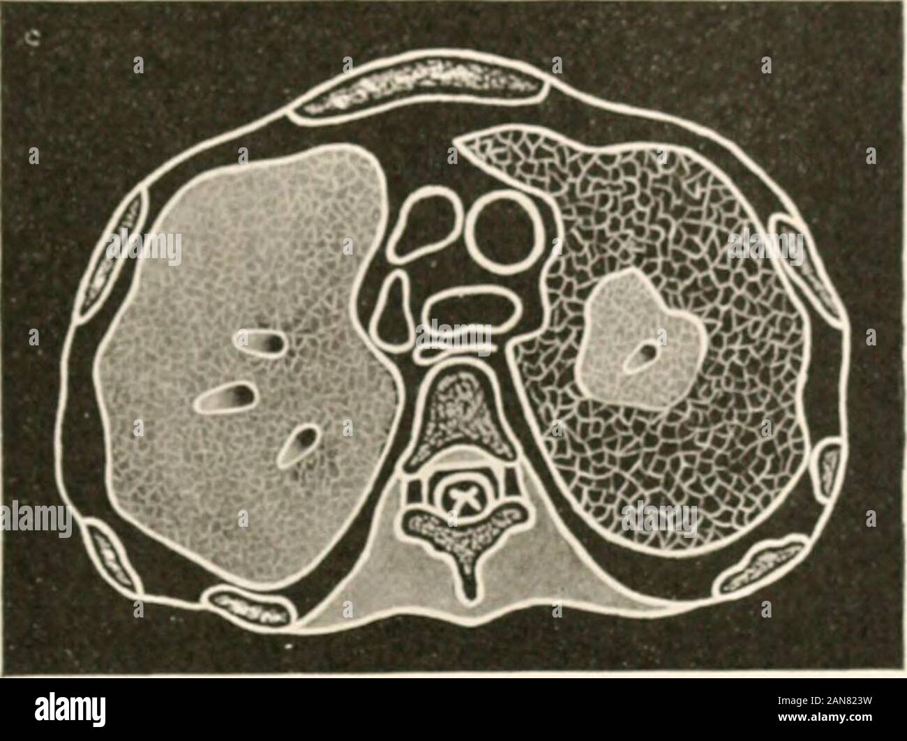 L'examen médical pour l'assurance vie et les méthodes cliniques : avec des chapitres sur l'assurance vie et d'assurance accident . Fig. 6i.-pleural..Une attention particulière doit être adressée à l'épanchement pulmonaire dans la plus grande. Le WLL l I I DE LA POITRINE 111 l i l i ? J'.( noN. Fig. 62. -Pneumonie lobaire (gauche) ; Centre de la pneumonie (Rigb La consolidation lobaire sur le côté droit présenterait les signes 1 olplete avec lassie solidification brevet bronches. ntral ana de consolidation produirait aucun signes de percussion, et être chieflydenoted par des tubu Banque D'Images
