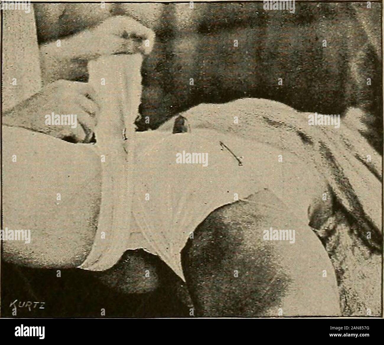 Les règles de la chirurgie aseptique et antiseptique ; un traité pratique à l'usage des étudiants et l'omnipraticien . Fig. 108.-Volkmanns-hanche reste. presses sont maintenues par un bandage spica en particulier sur les bords, et ne devrait pas être trop faibles. Six ou sept jours après l'op-tion les pansements doivent êtremodifiés, afin de permettre le retrait du tube de drainage. Cinq ou plus sixdays terminera l es-sential partie de la guérison. Les patients entrailles doiventêtre propose quarante-huit heures après l'opération par un grand enemaof-savon de l'eau. La fièvre devrait d'irritation péritonéale, setin asaline purger peut b Banque D'Images